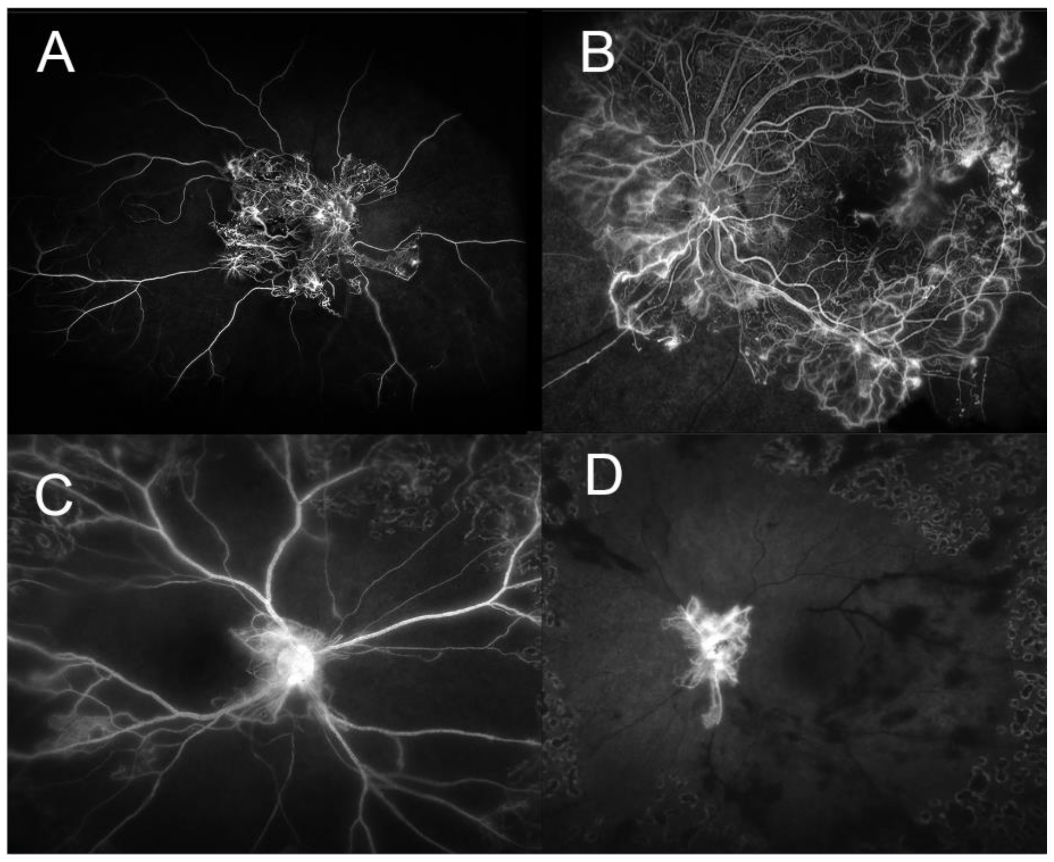 IJMS | Free Full-Text | The Vitreous Ecosystem in Diabetic