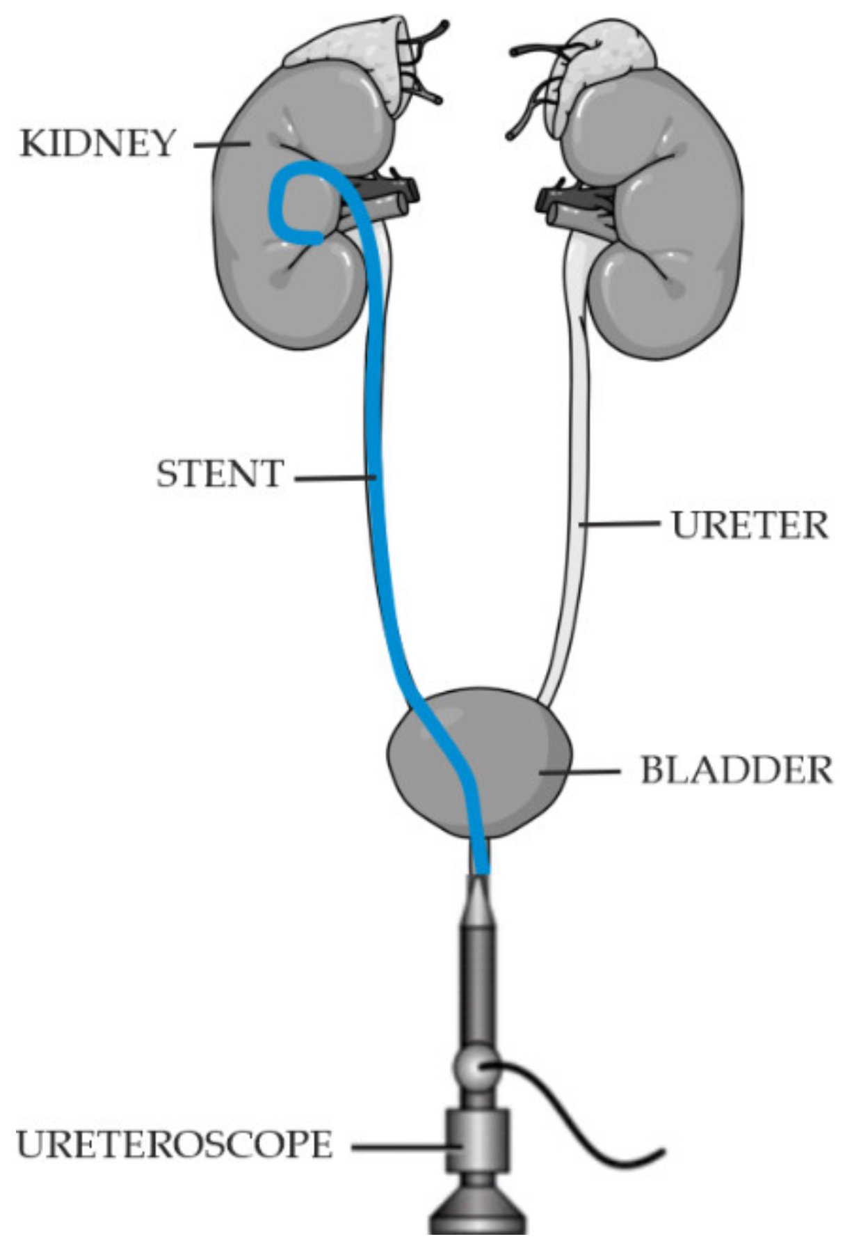 Double j ureteral stent