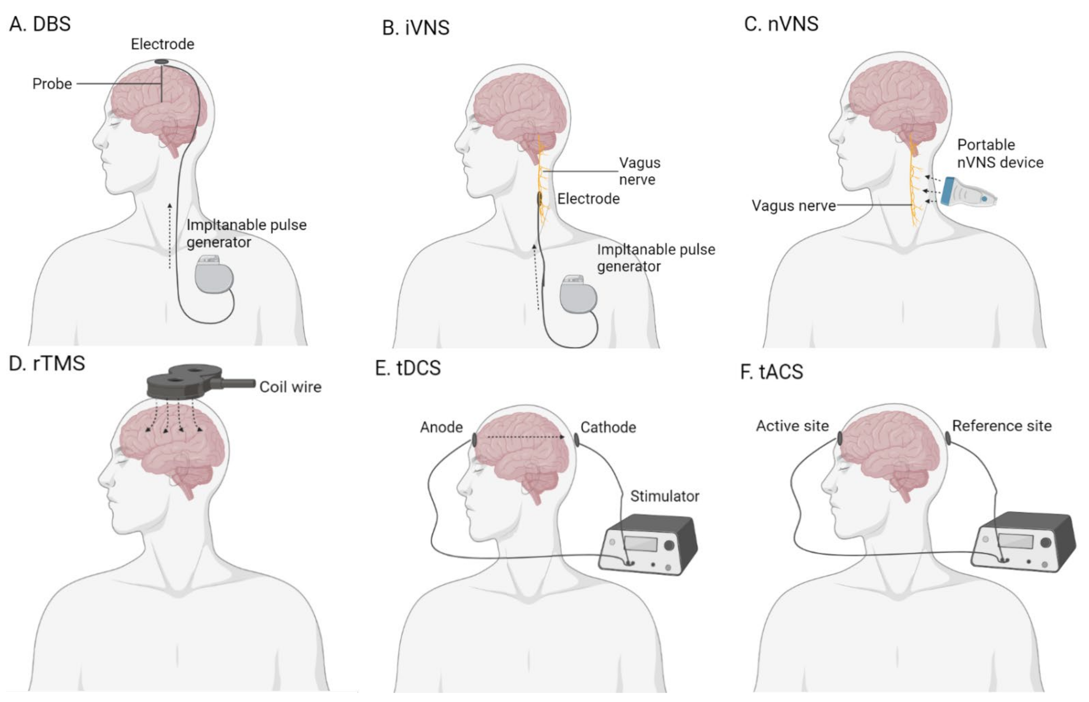 Home-based transcranial alternating current stimulation (tACS) in  Alzheimer's disease: rationale and study design, Alzheimer's Research &  Therapy