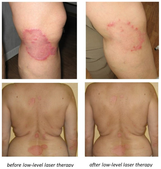 seborrhea pikkelysömör psoriasis kezelése psoriasis images