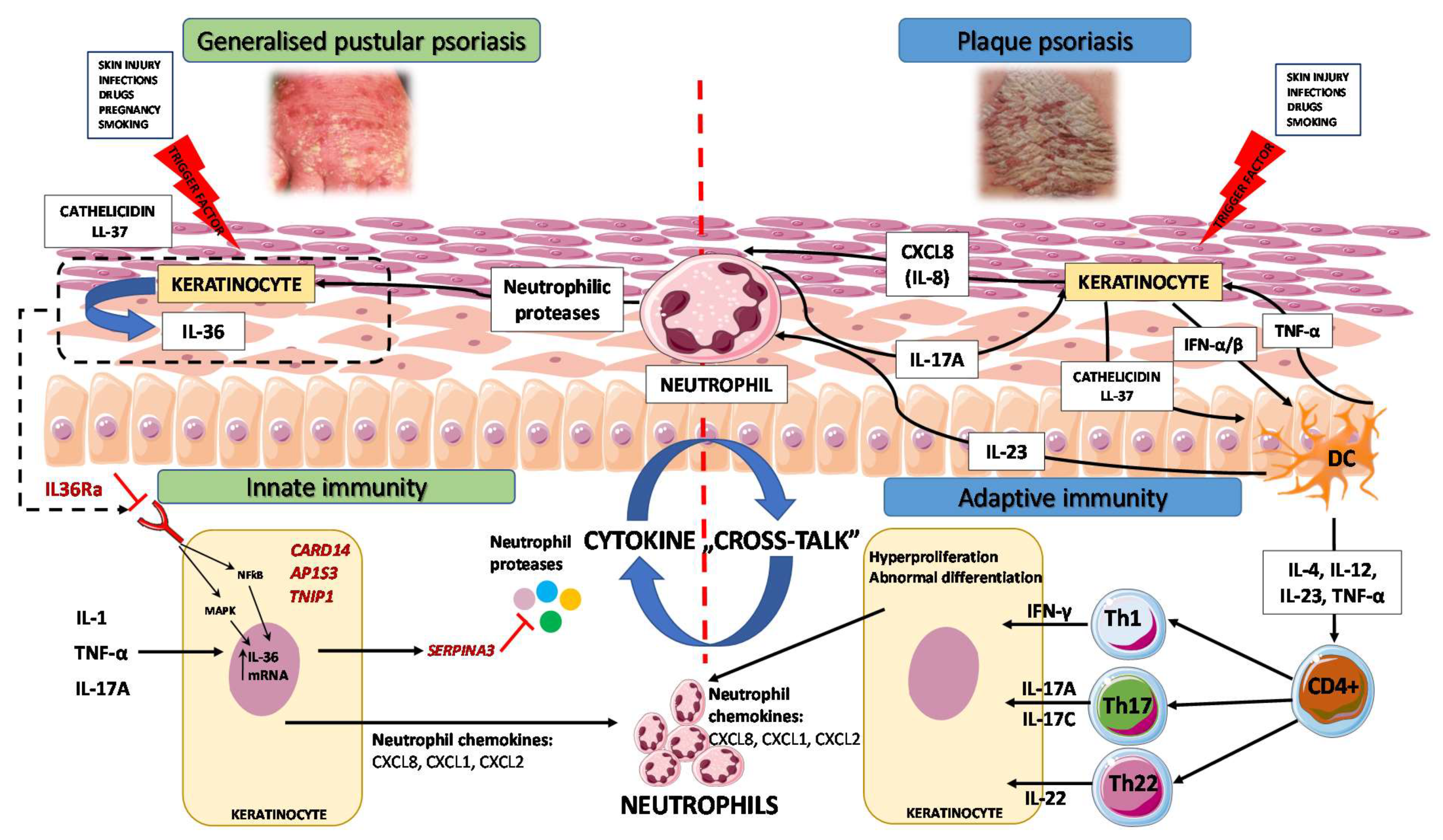 pustular psoriasis remission