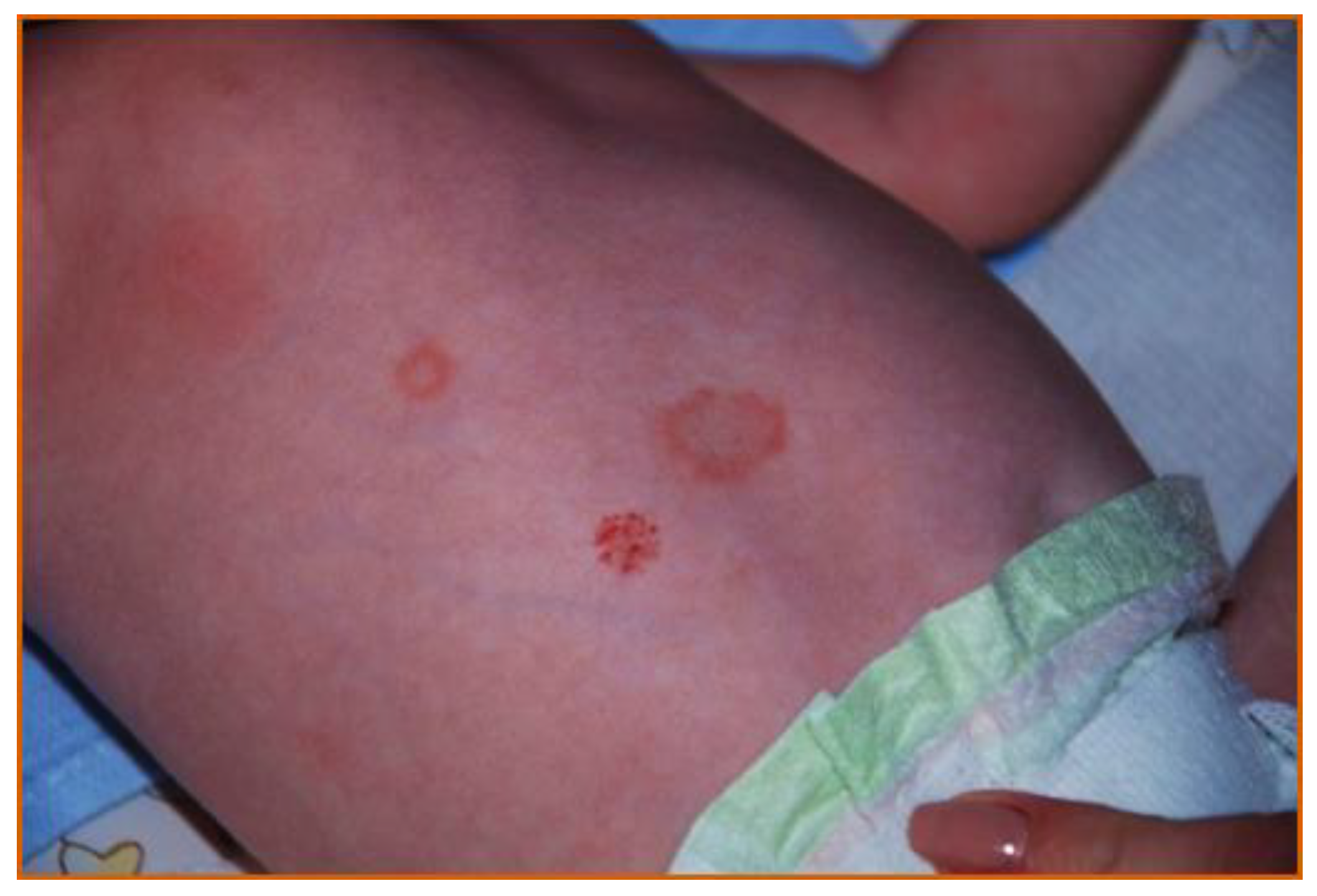 Tinea Faciei (Ringworm on Face): Causes, Symptoms, & Treatment