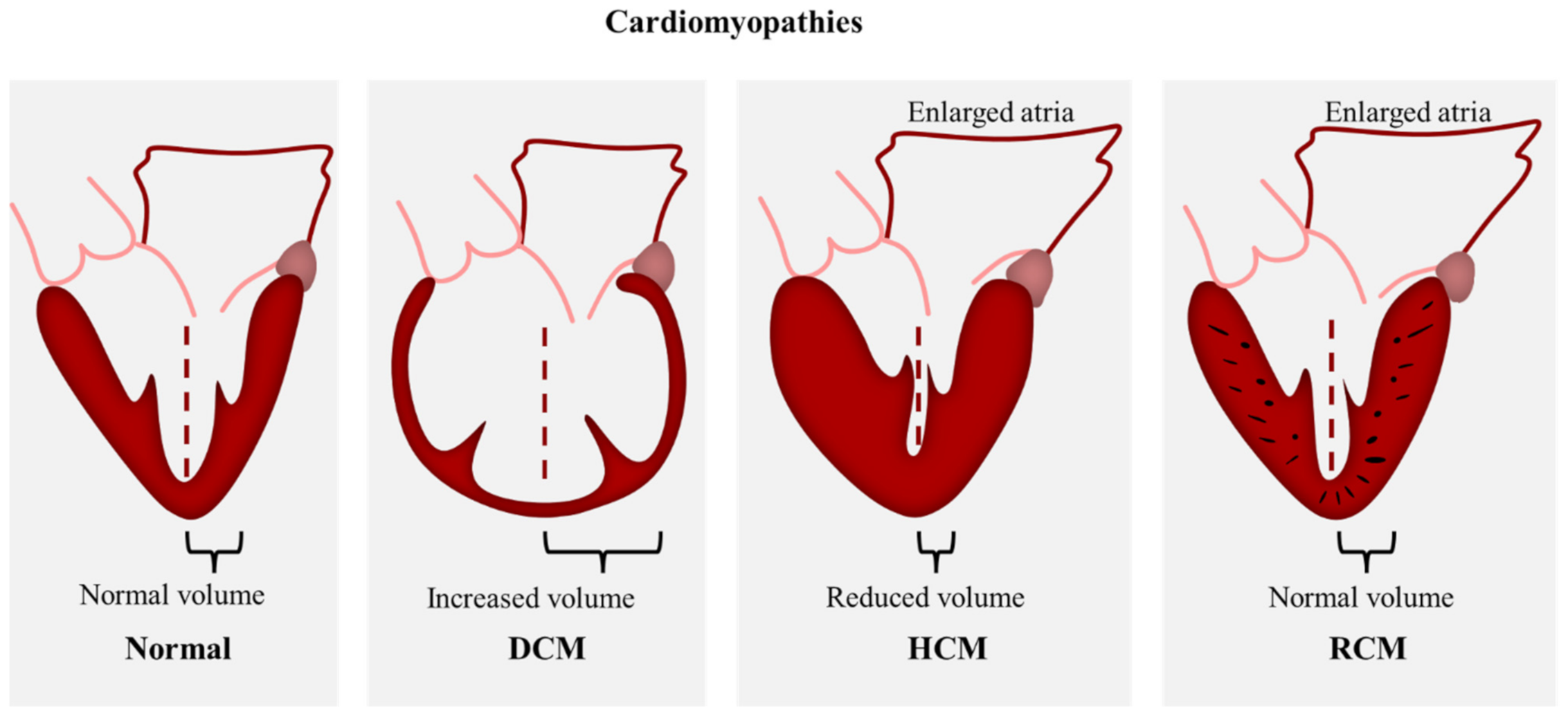 Cardiomyopathy online