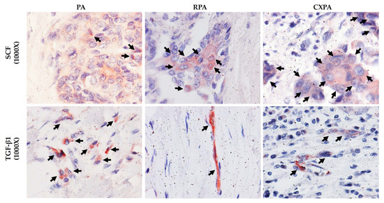 Increase in Chymase-Positive Mast Cells in Recurrent Pleomorphic ...