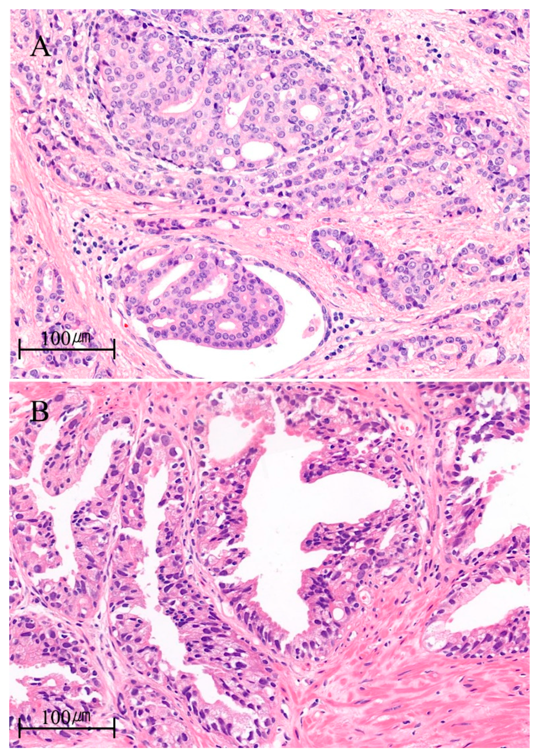 Intraductal papilloma with dcis pathology outlines
