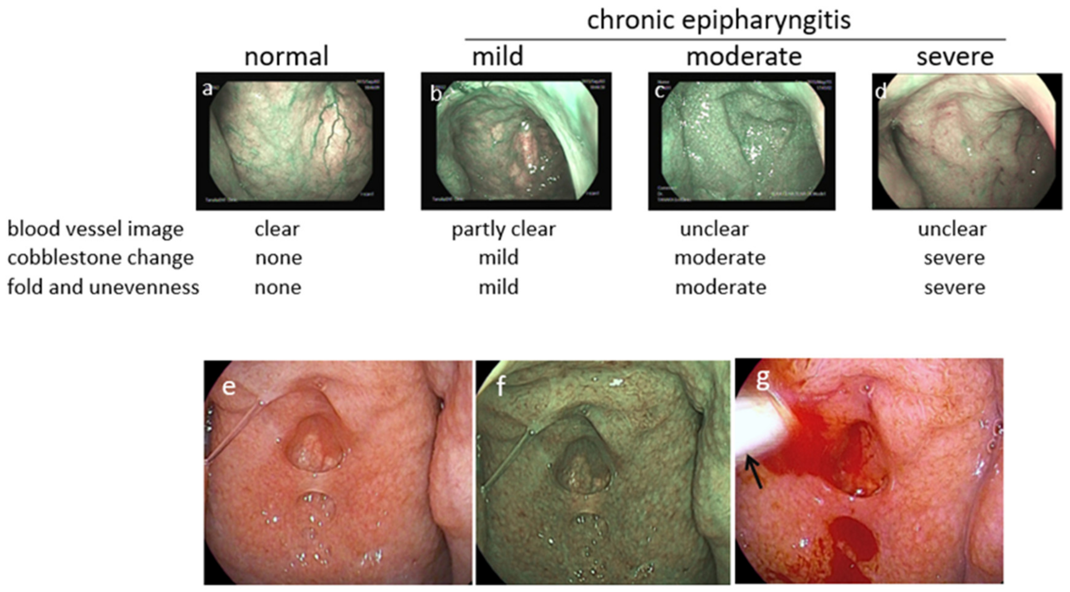 Adenoids and Tonsils: Immune System's Tireless Gatekeepers | Encyclopedia  MDPI