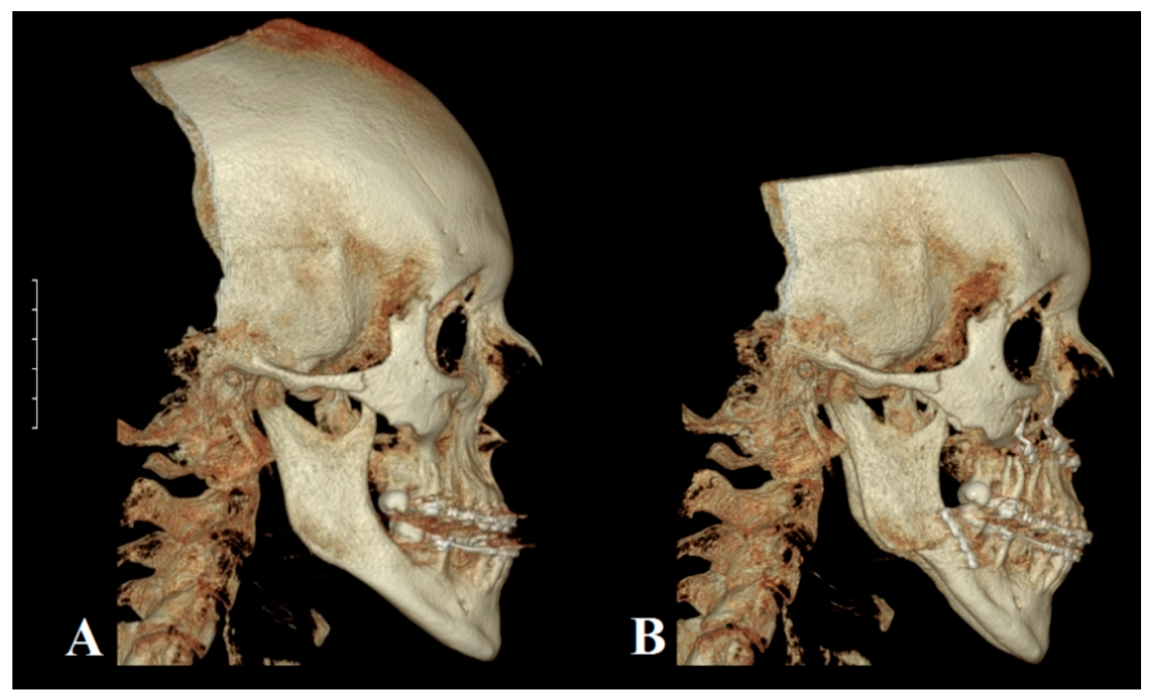 Historical Nonfiction — Pathologic mandibular prognathism, or