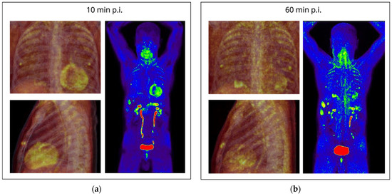 Shining Damaged Hearts: Immunotherapy-Related Cardiotoxicity in