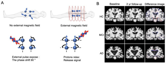 Neuroimaging Modalities in Alzheimer's Disease: Diagnosis and