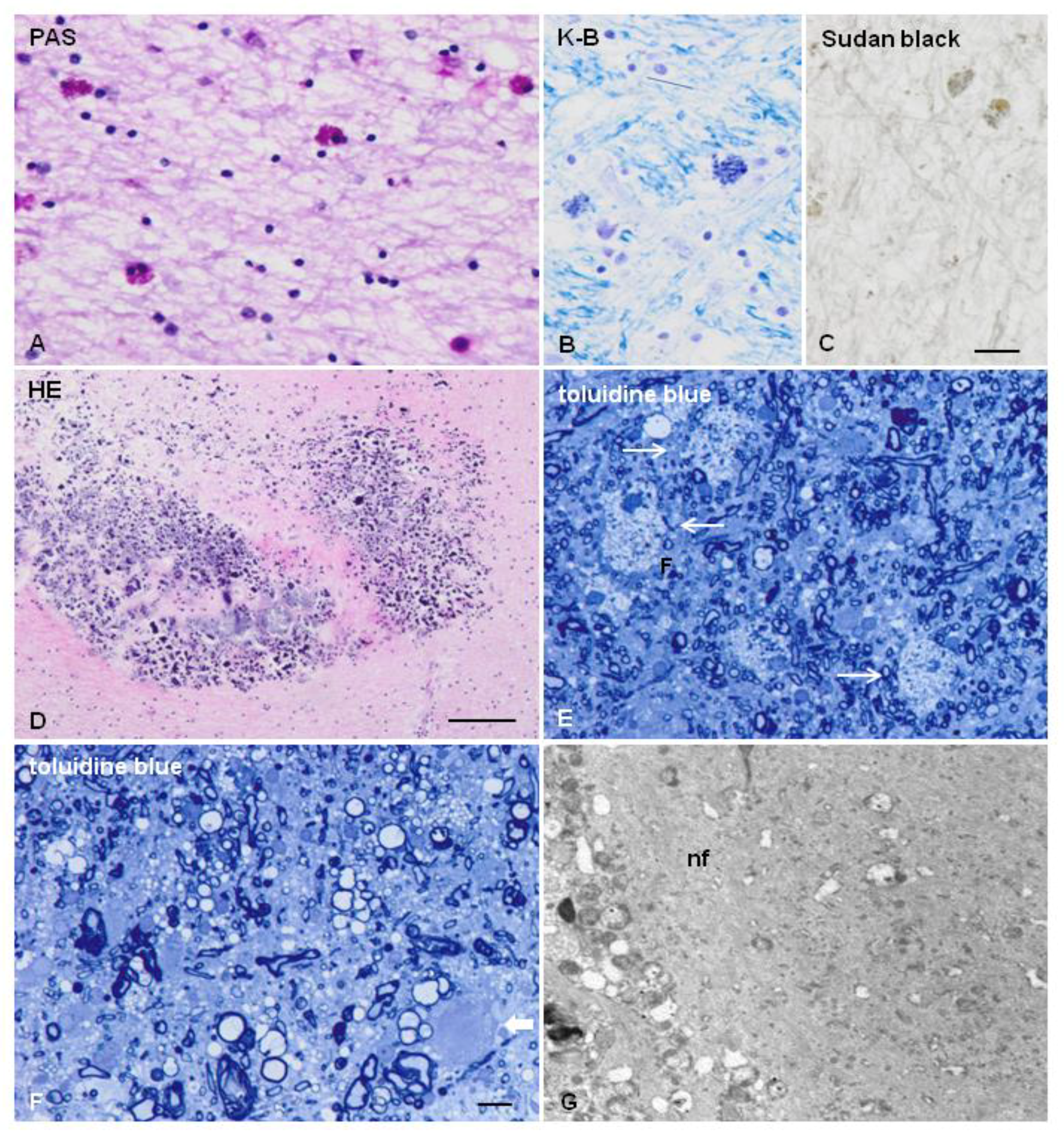 The Primary Microglial Leukodystrophies: A Review