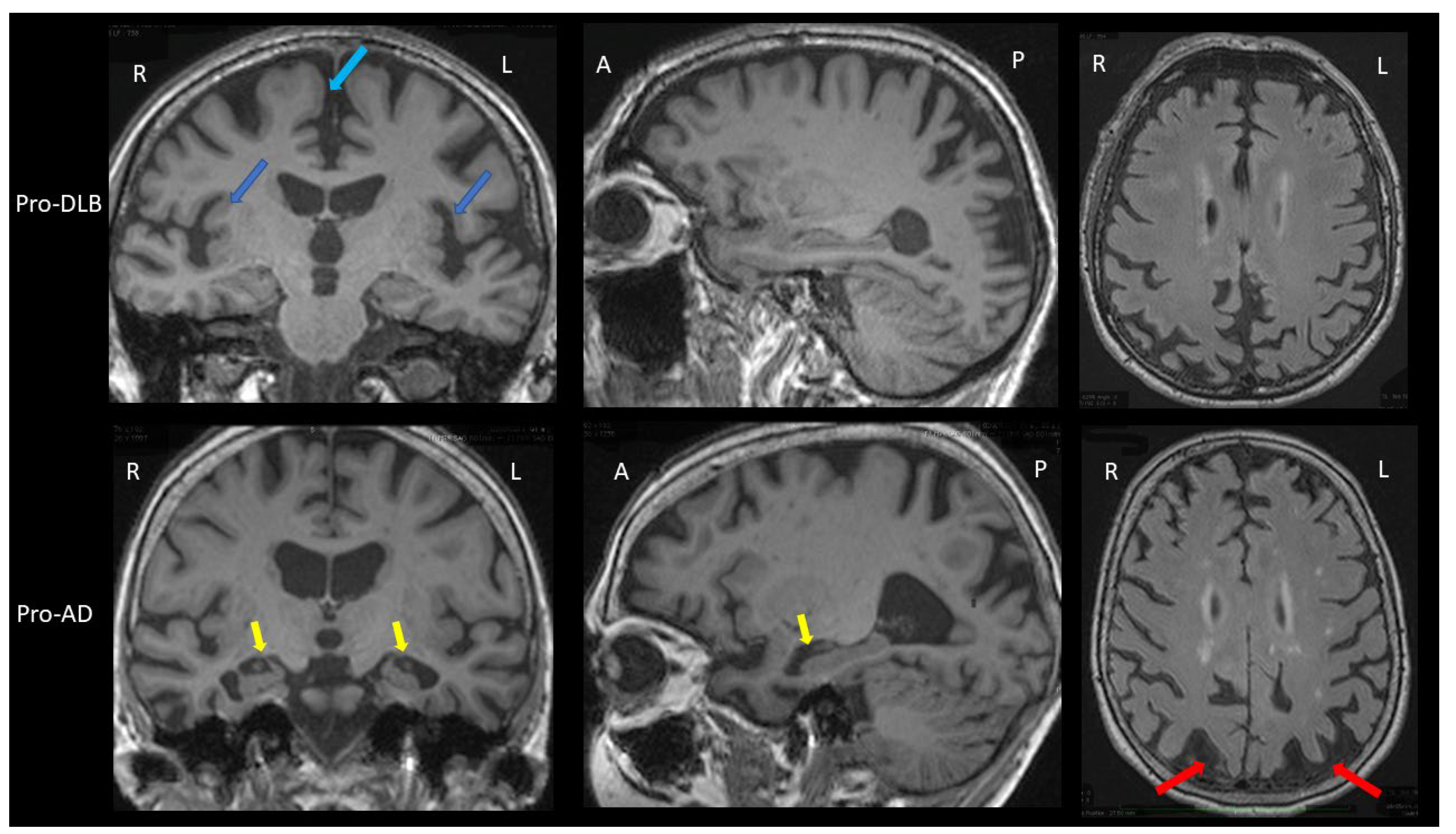 Biomarkers of Dementia with Lewy Bodies: Differential Diagnostic 