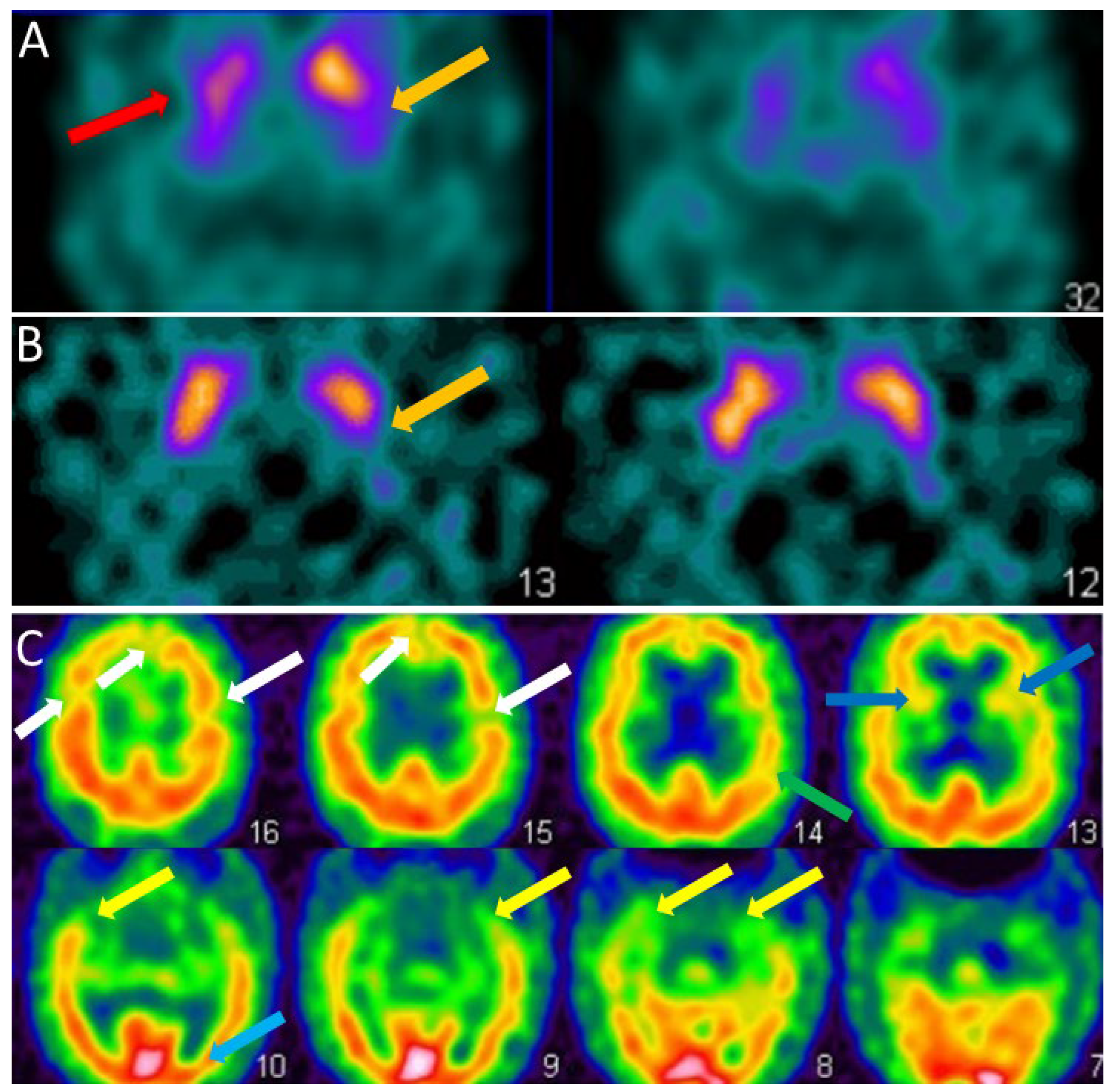 Biomarkers of Dementia with Lewy Bodies: Differential