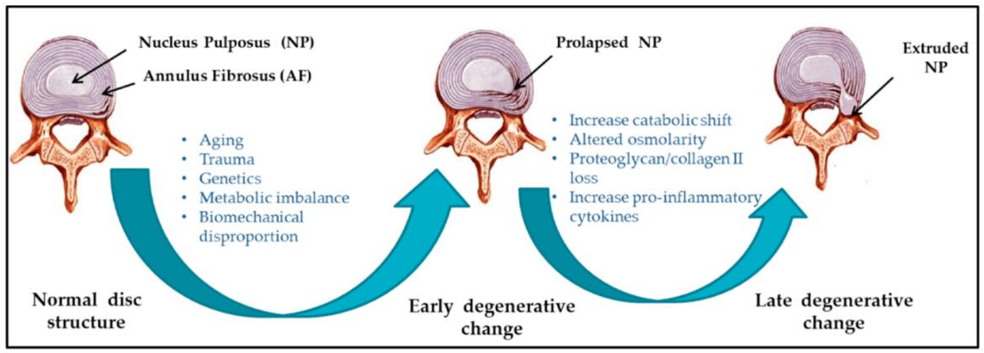 Recent Advances in Managing Spinal Intervertebral Discs