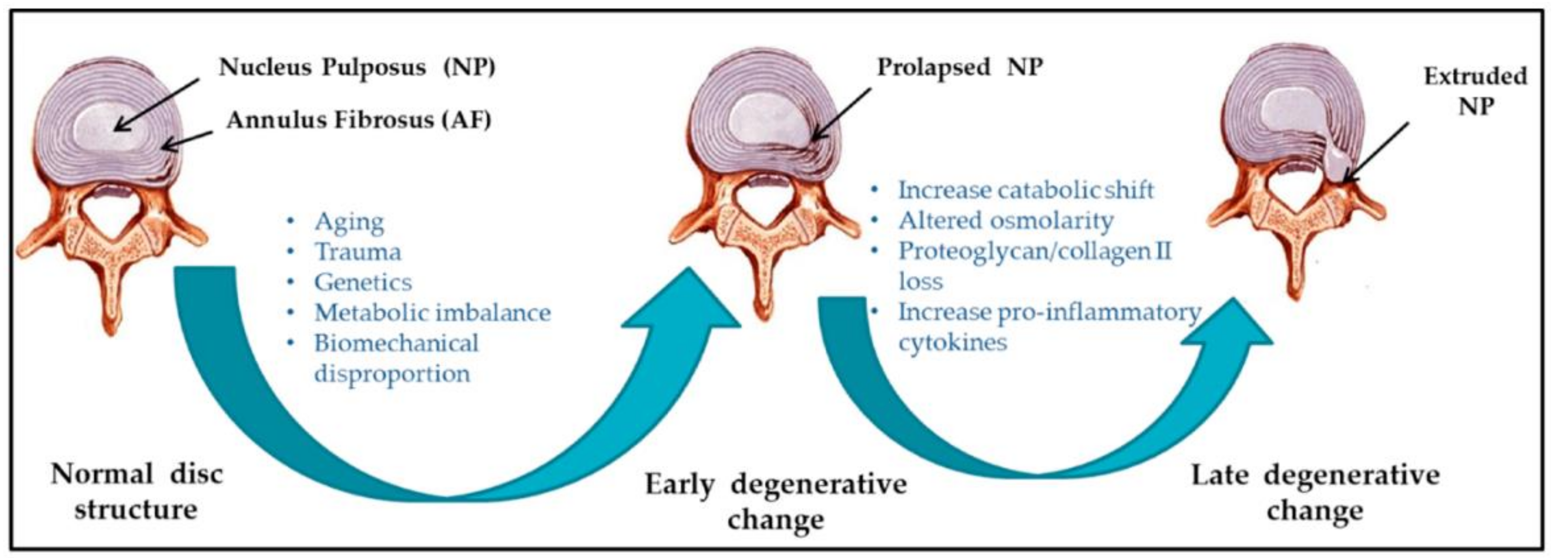 The Aging Spine and Degenerative Disc Disease