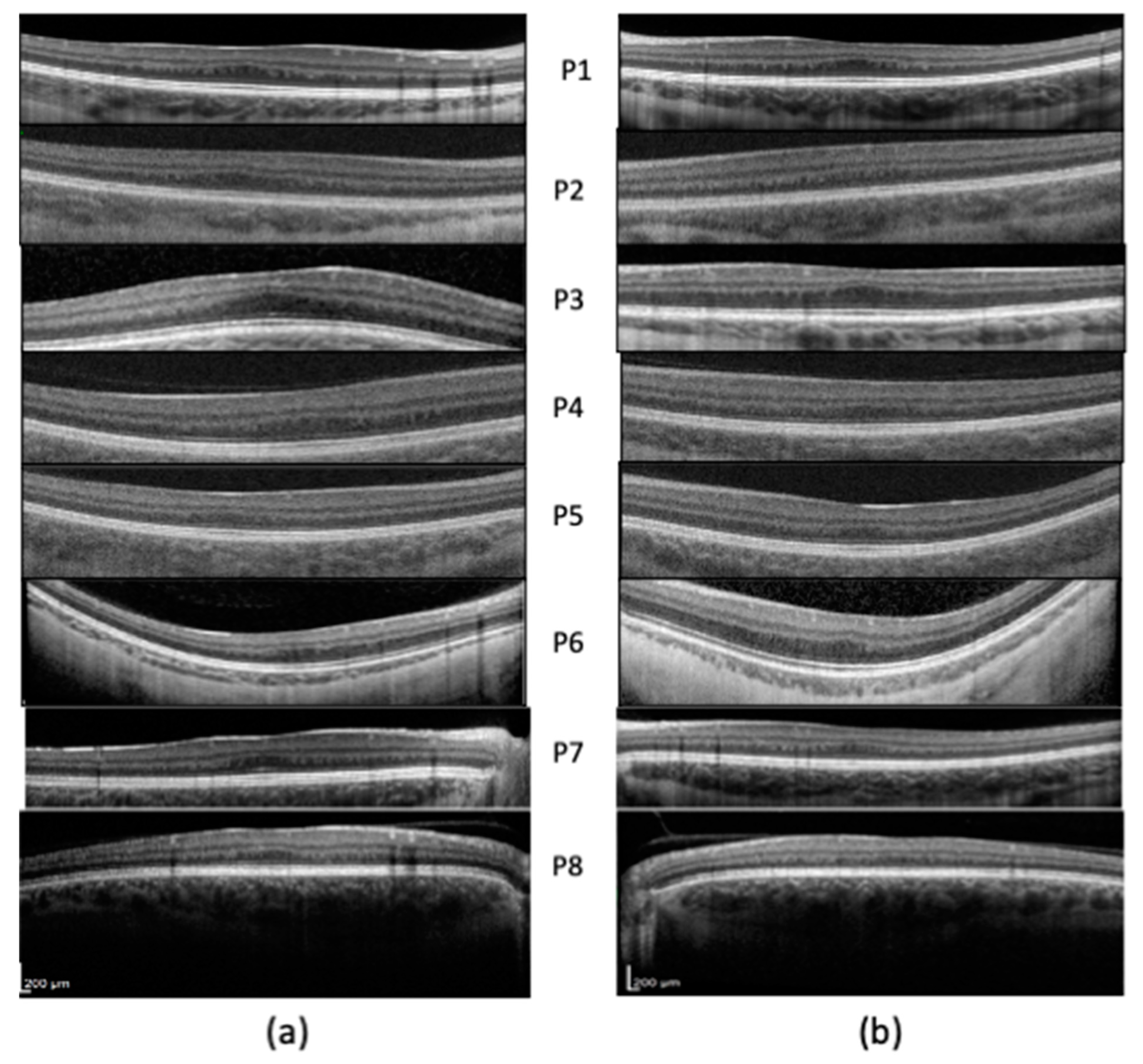 IJMS | Free Full-Text | Expanding the Spectrum of Oculocutaneous Albinism: Does Isolated Foveal Hypoplasia Really Exist? IJMS | Free Full-Text | Expanding the Spectrum of Oculocutaneous Albinism: Does Isolated Foveal Hypoplasia Really Exist?