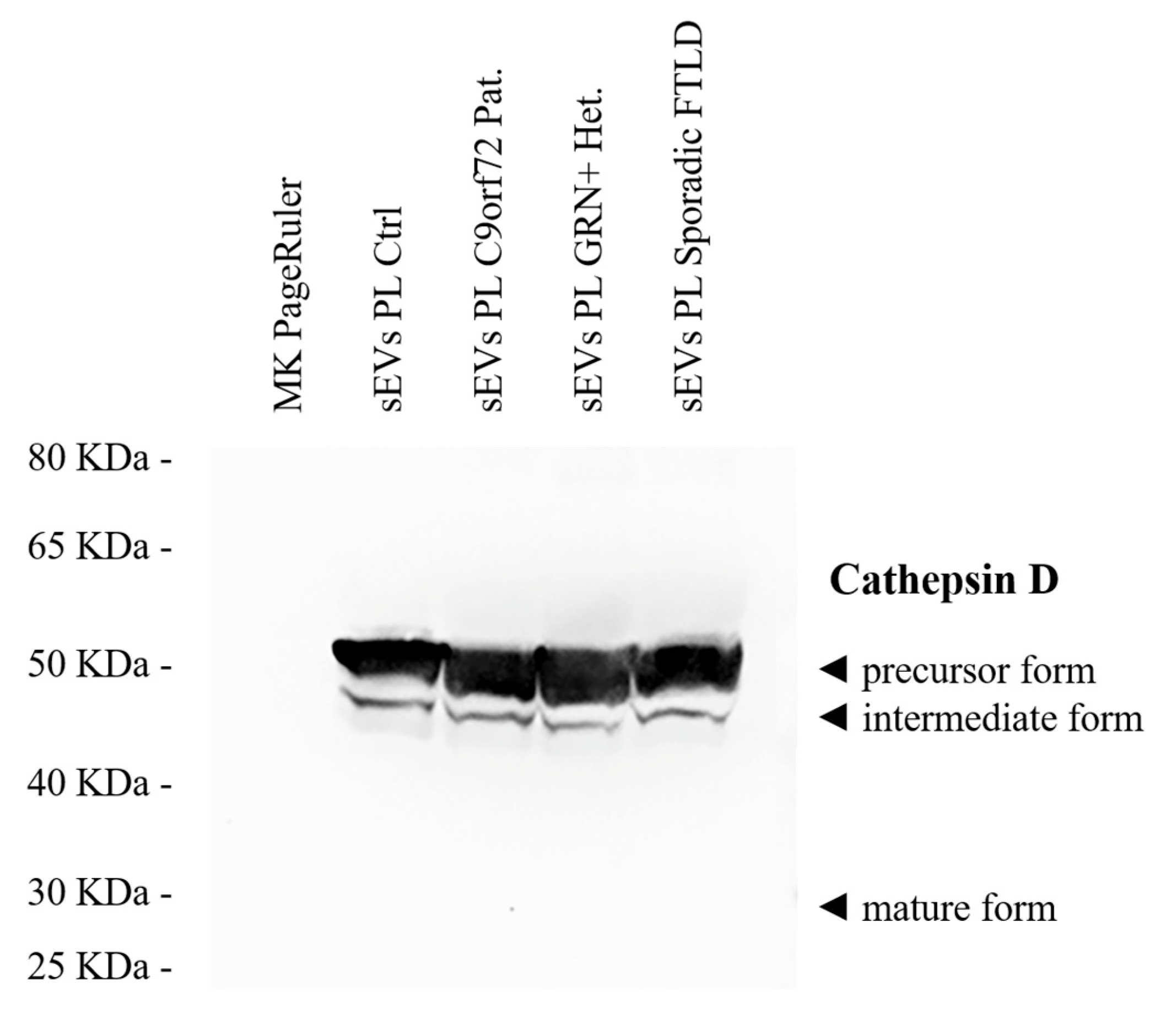 Plasma Small Extracellular Vesicle Cathepsin D Dysregulation