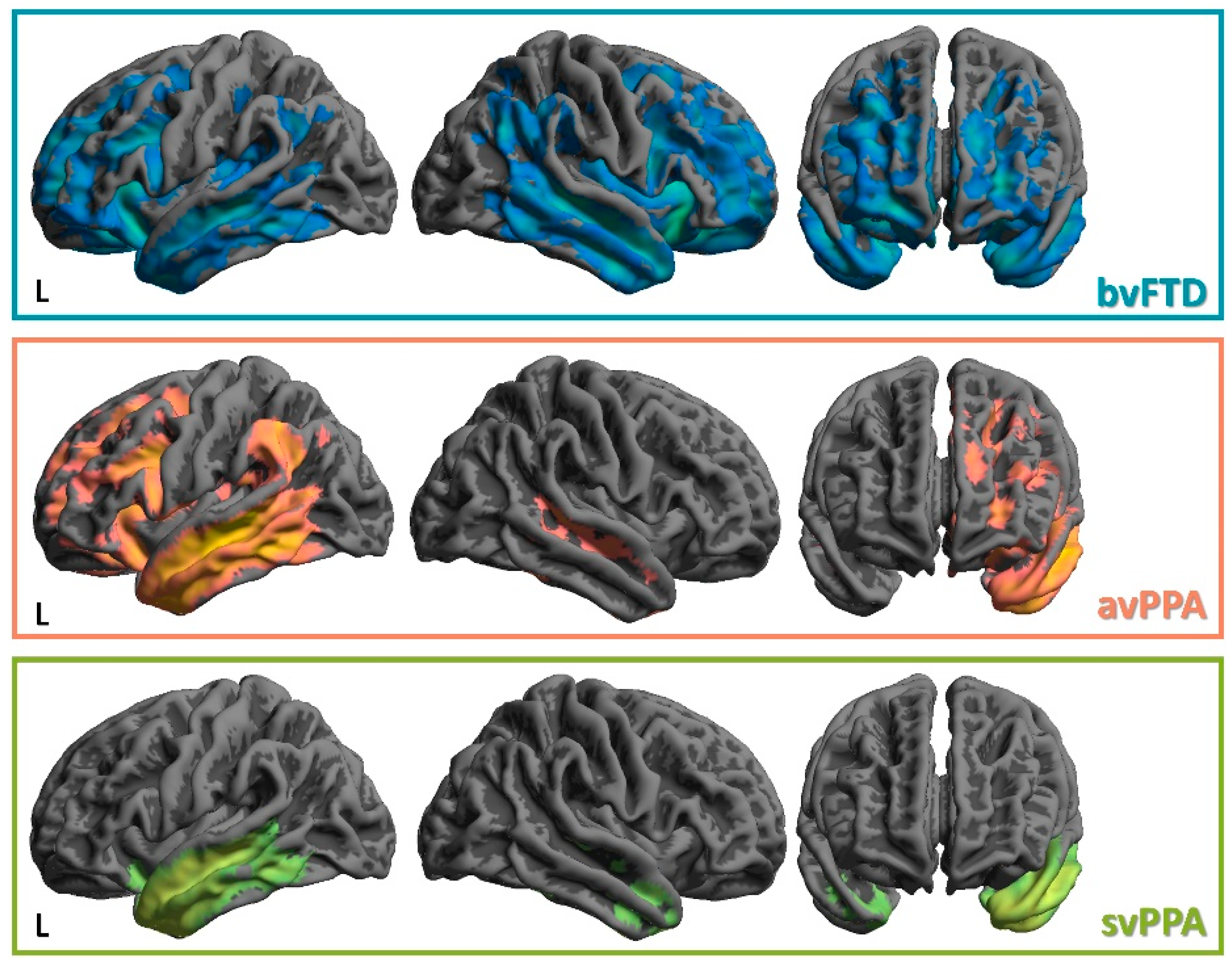 IJMS | Free Full-Text | Dissecting the Many Faces of Frontotemporal