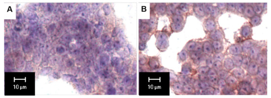 Profound Impact of Decline in N-Acetylgalactosamine-4-Sulfatase
