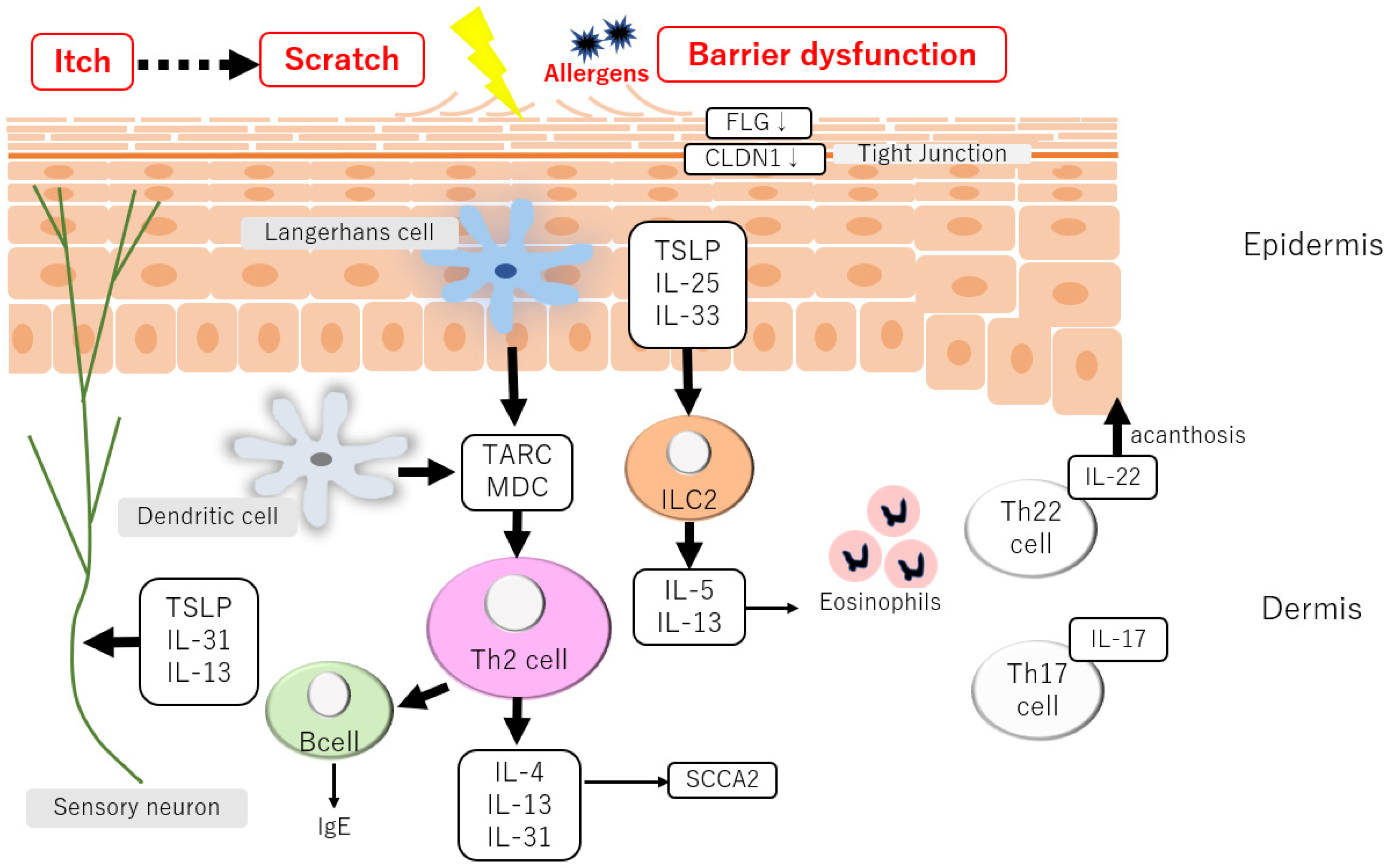 その他 Pathogenesis and Management of Atopic Involvement of Atopic Dermatitis in the Development of