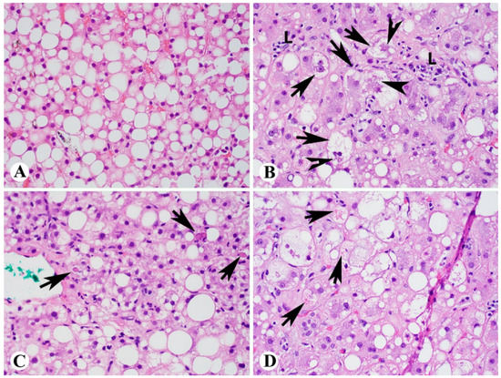 Exosomal microRNAs and Progression of Nonalcoholic