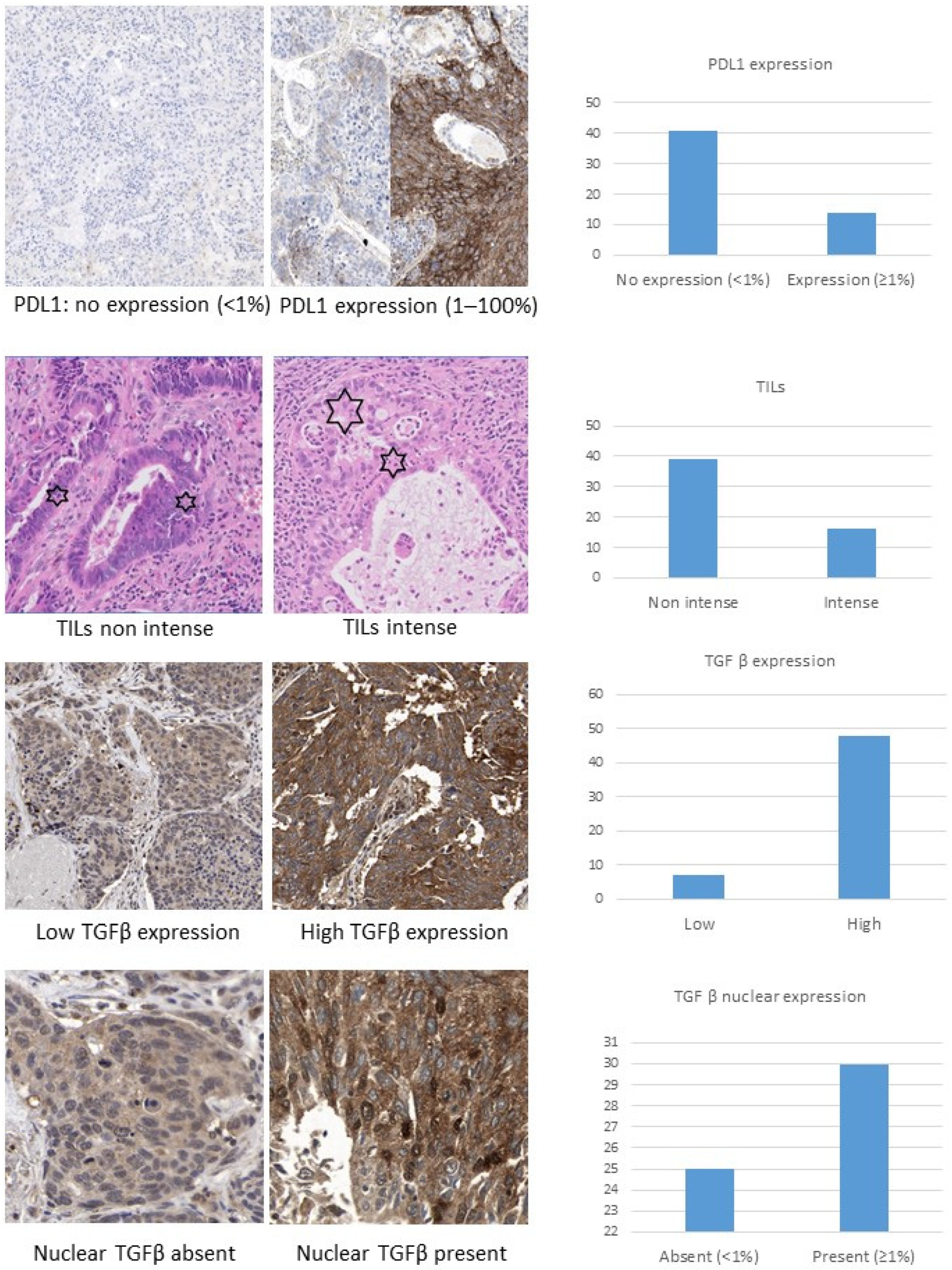 アート TFG-β Nuclear Staining as a Potential Relapse Risk Factor in