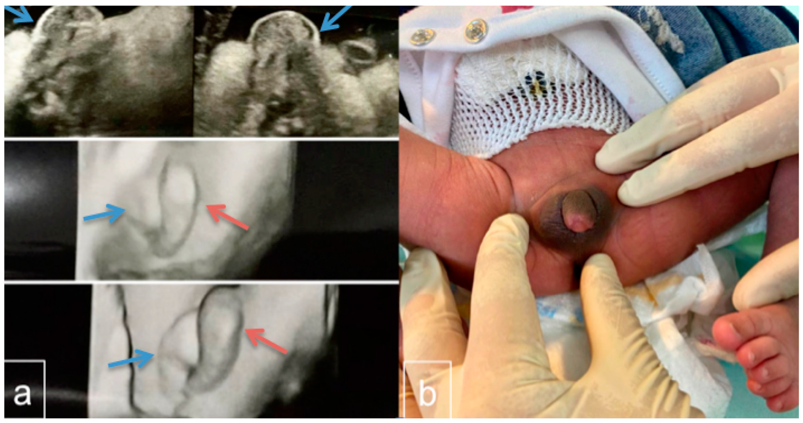 IJMS | Free Full-Text | Turner Syndrome Mosaicism 45,X/46,XY with Genital  Ambiguity and Duchenne Muscular Dystrophy: Translational Approach of a Rare  Italian Case
