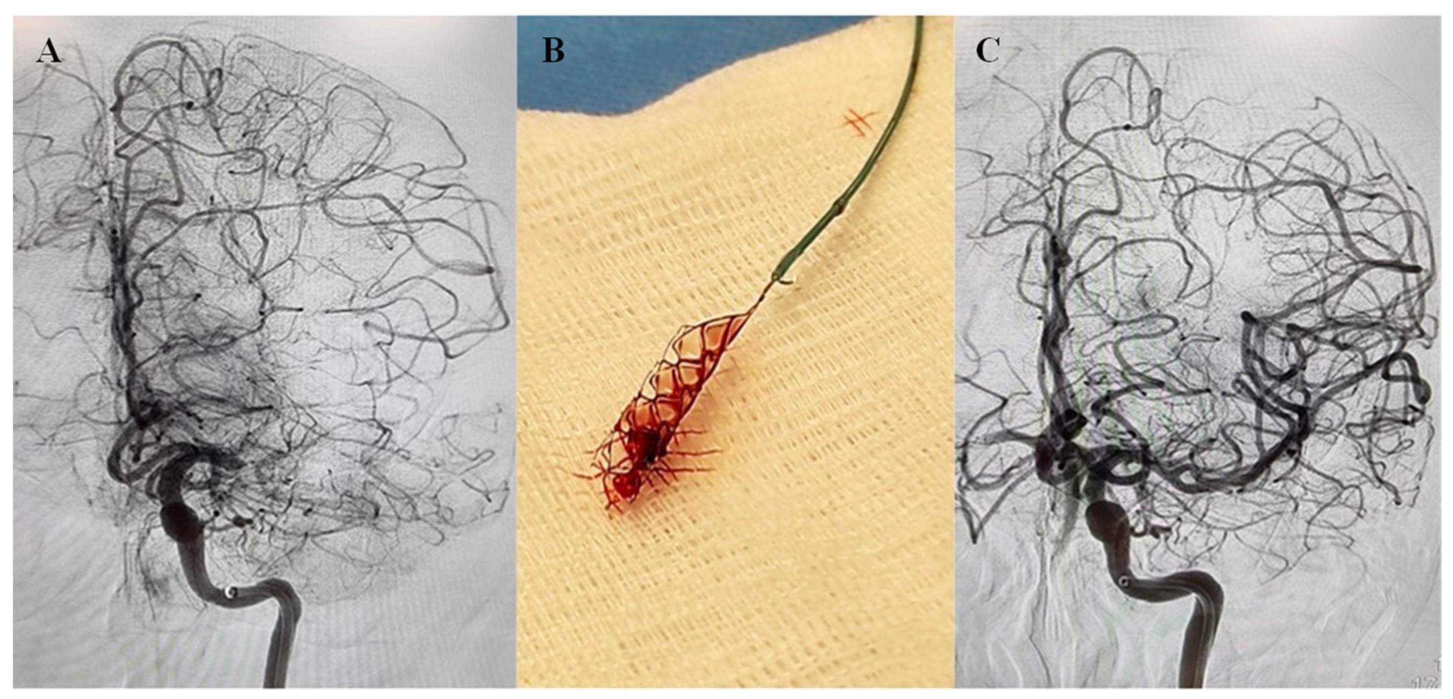 Platelet–Neutrophil Association in NETs-Rich Areas in the 