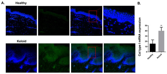 Increased Expression of Galectin-3 in Skin Fibrosis: Evidence from