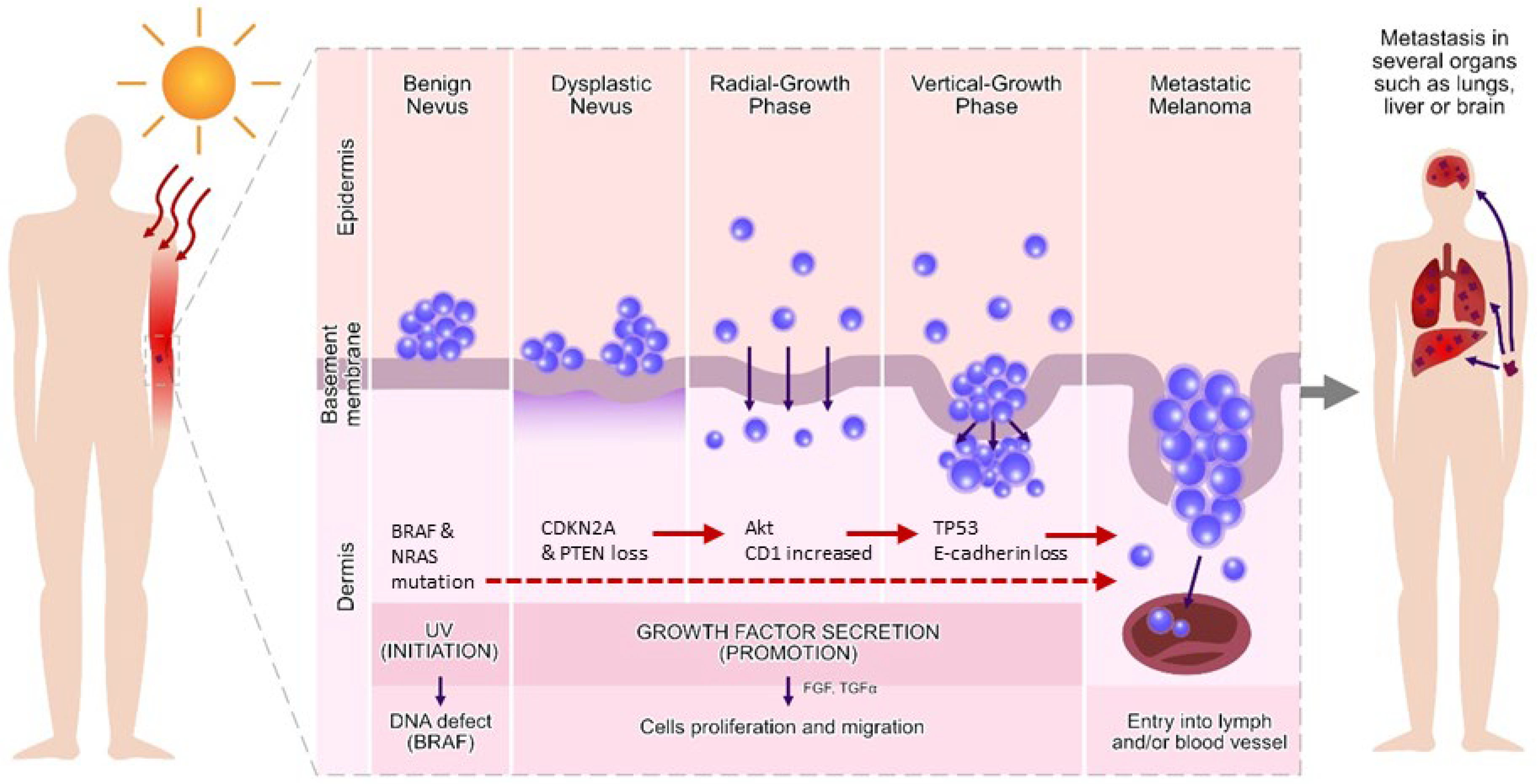 IJMS Free FullText Role of miRNA in Melanoma Development and