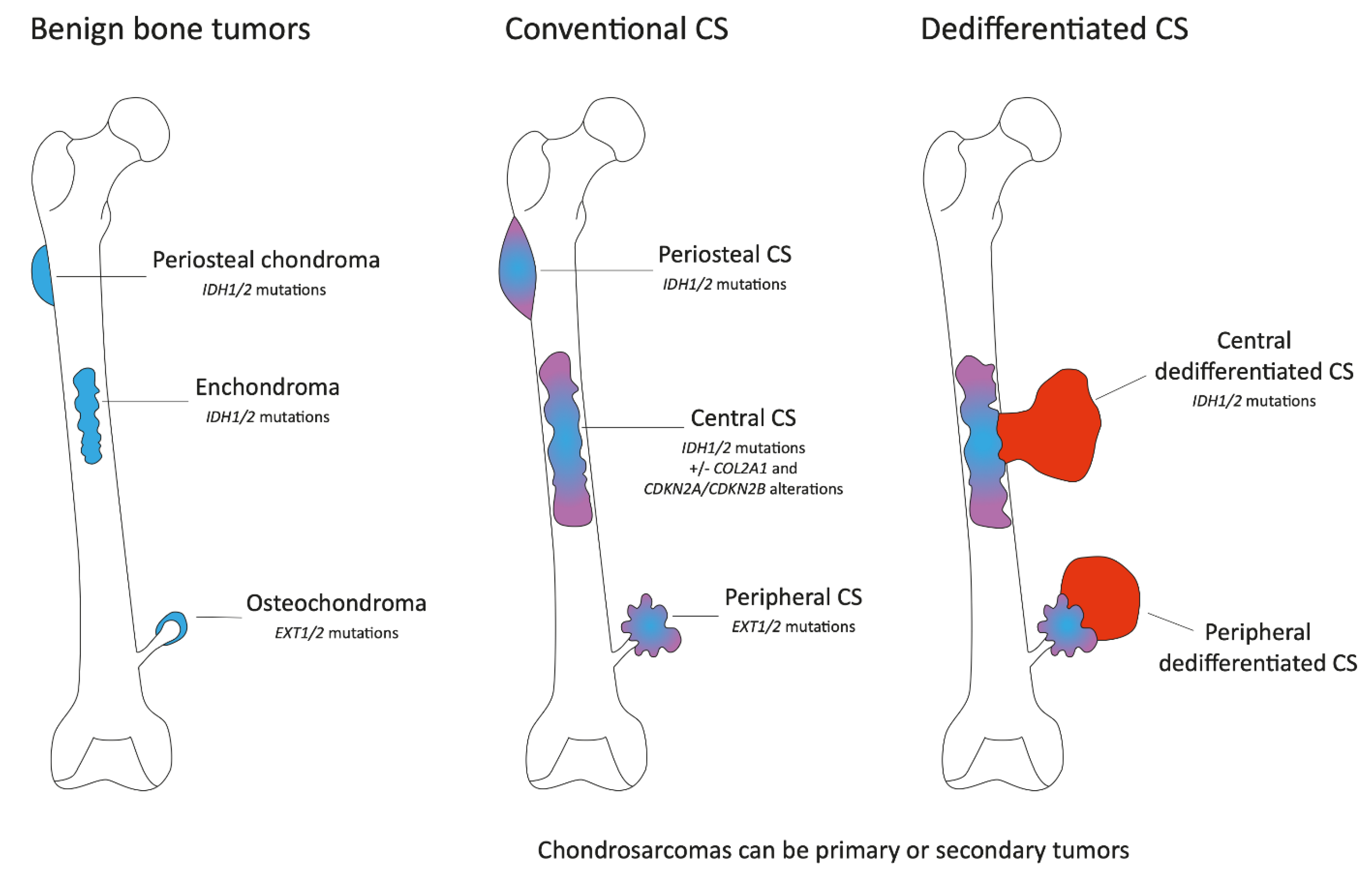 chondrosarcoma