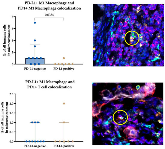 Spatial Profile of Tumor Microenvironment in PD-L1-Negative and PD-L1 ...