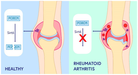 Role of Sirtuins in the Pathogenesis of Rheumatoid Arthritis Role of Sirtuins in the Pathogenesis of Rheumatoid Arthritis