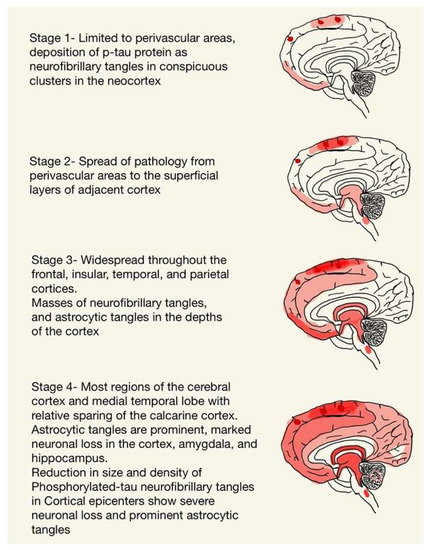 Understanding the Molecular Progression of Chronic Traumatic 