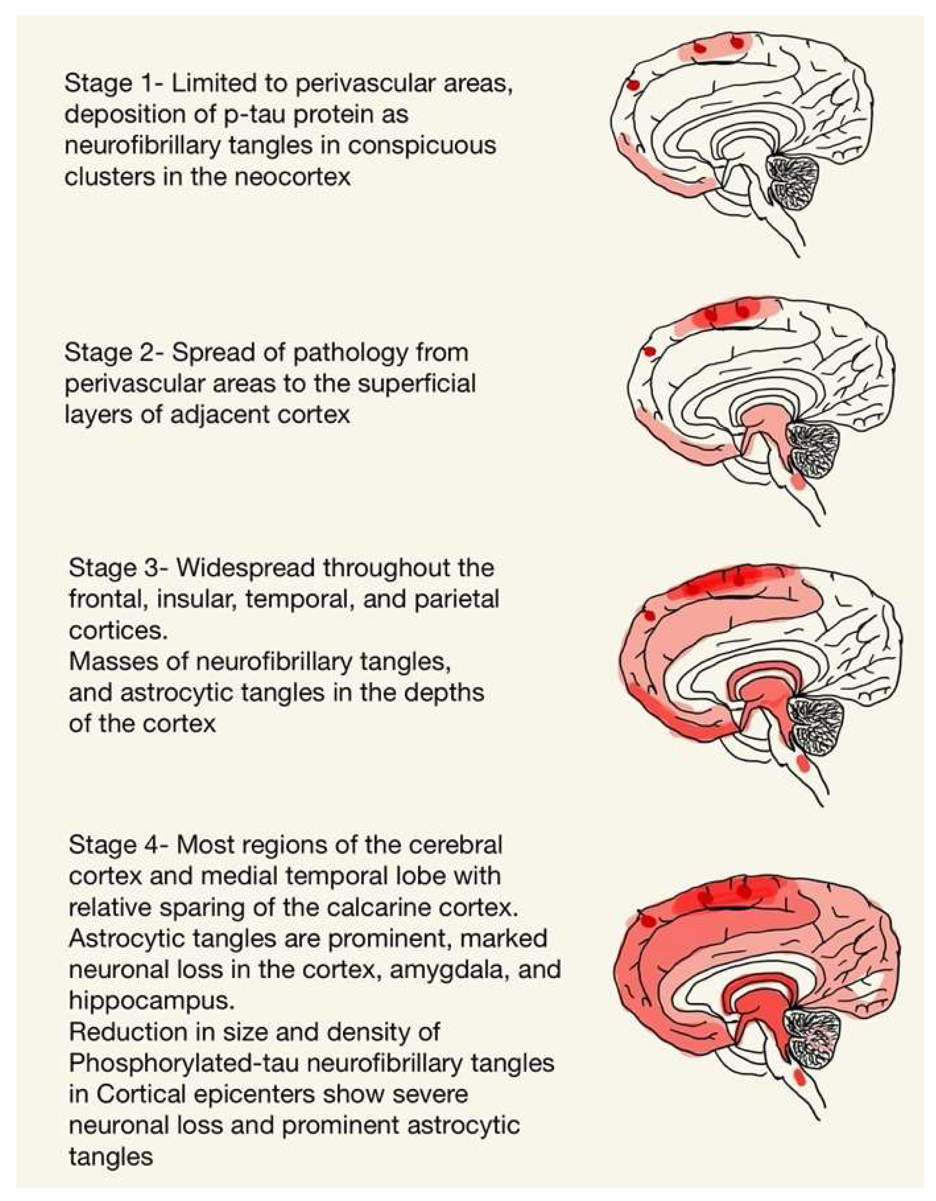 Understanding The Molecular Progression Of Chronic Traumatic understanding-the-molecular-progression-of-chronic-traumatic