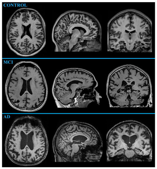 Imaging Methods Applicable in the Diagnostics of Alzheimer's