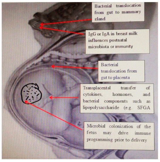 Programming Factors of Neonatal Intestinal Dysbiosis as a Cause of