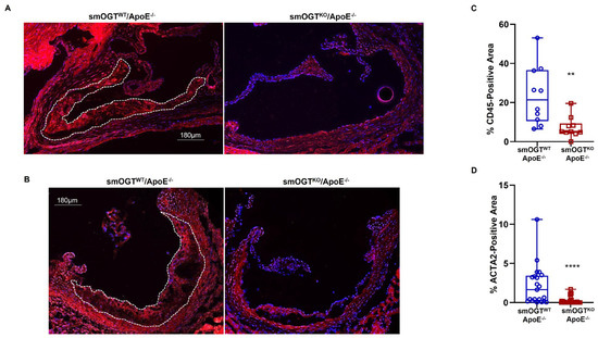 Deletion of Smooth Muscle O-GlcNAc Transferase Prevents