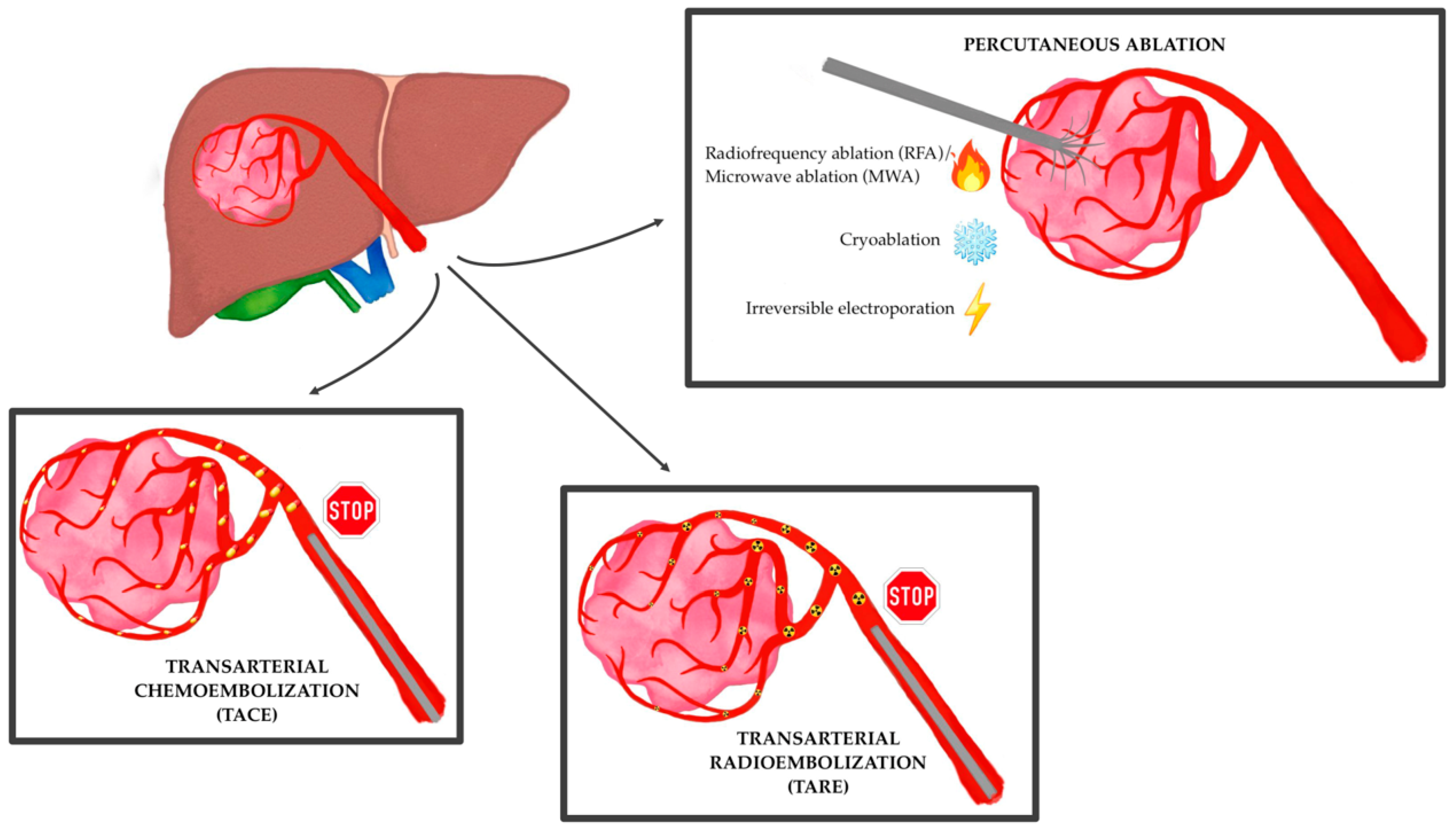 The Synergistic Effect of Interventional Locoregional