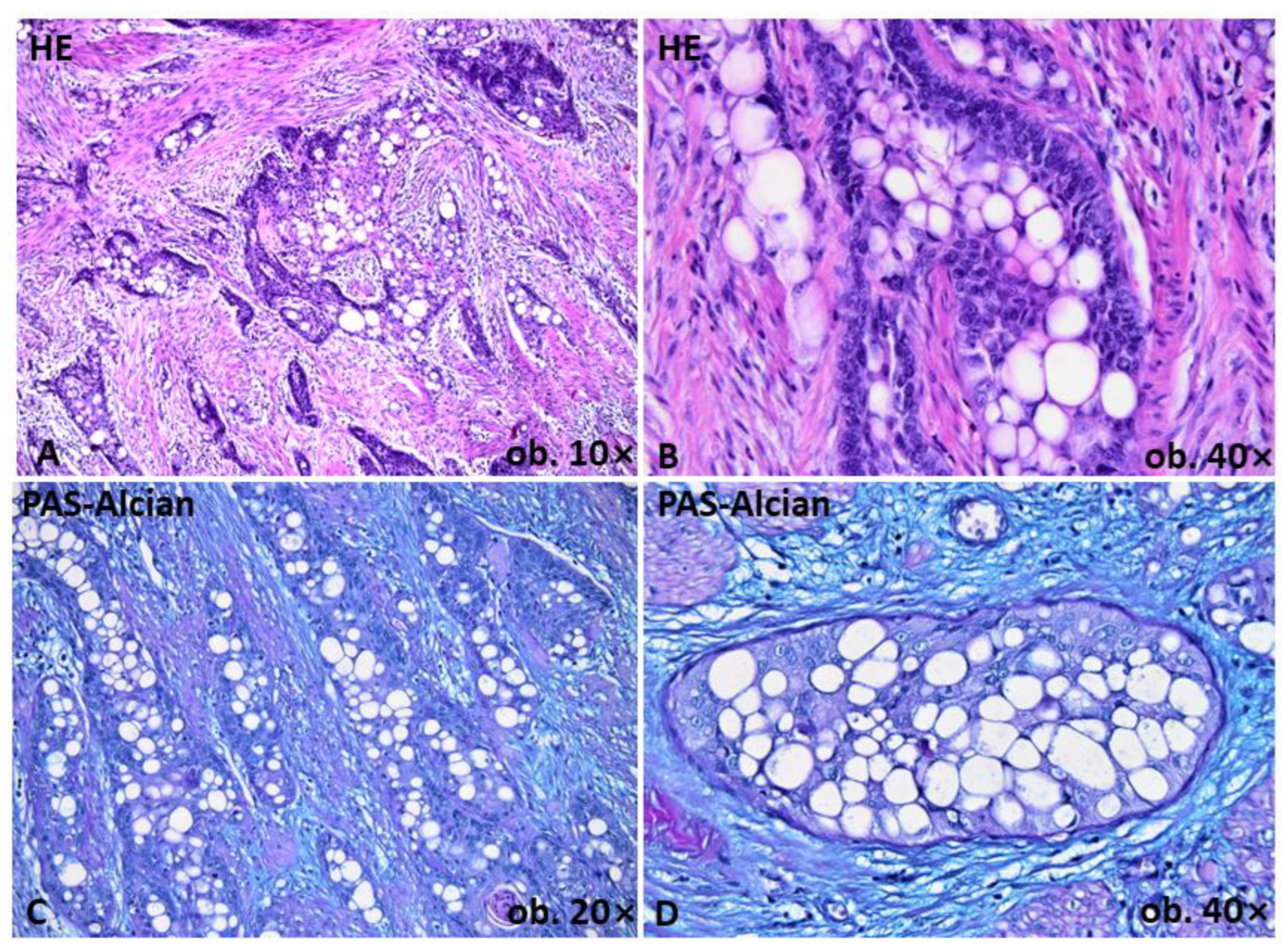 Signet ring cell carcinoma arising from sacrococcygeal teratoma: a case  report and review of the literature - Pengfei Zhou, Shiju Liu, Huiju Yang,  Yaxin Jiang, Xiang Liu, Dianwen Liu, 2019