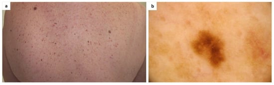 The patient exhibits further signs of basal cell nevus syndrome