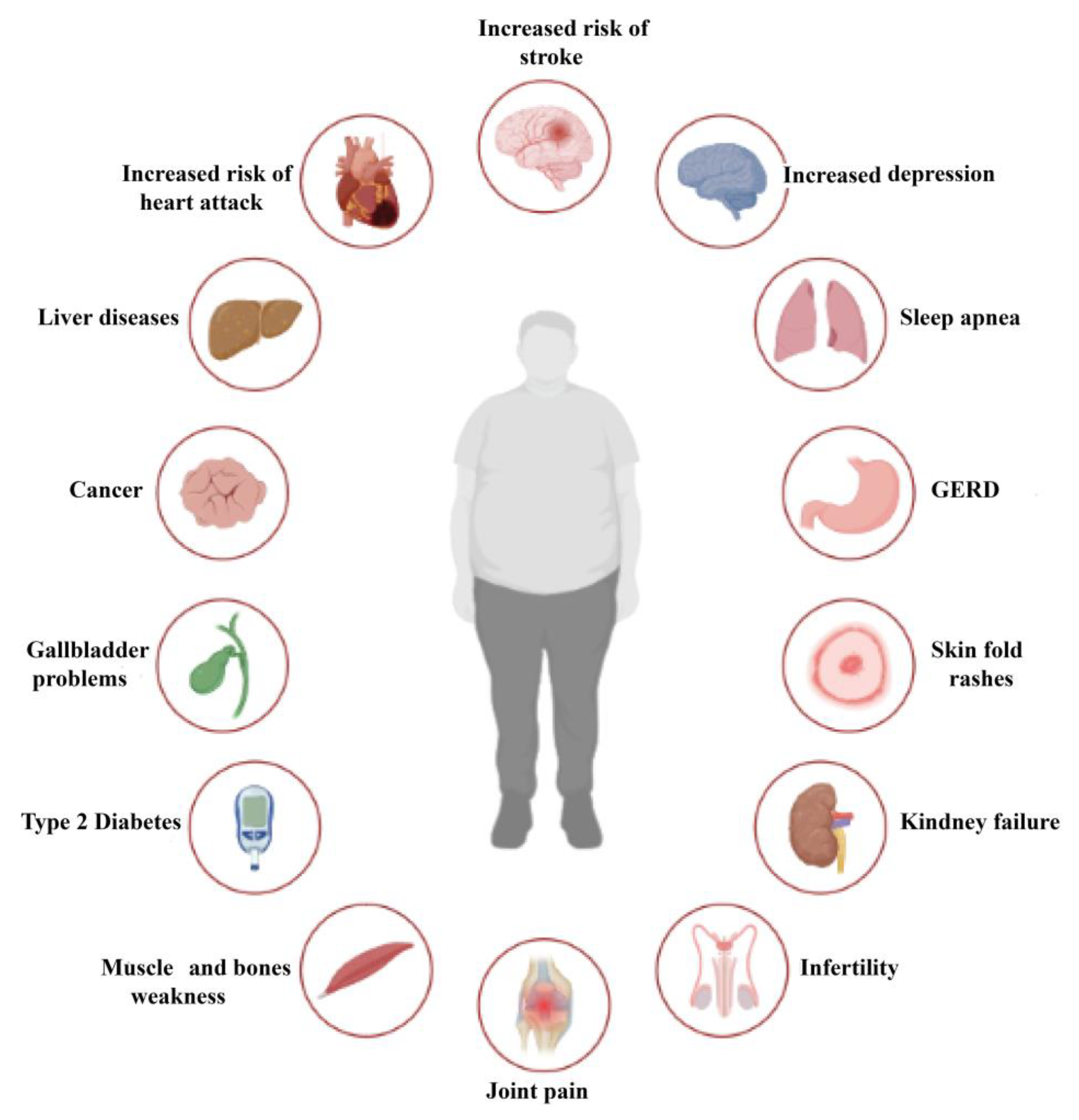 Graphic of complications from obesity listing: increased risk of stroke, depression, heart attack, liver diseases, cancer, gallbladder problems, type 2 diabetes, muscle and bone weakness, joint pain, infertility, kidney failure, skin fold rashes, GERD and sleep apnea.