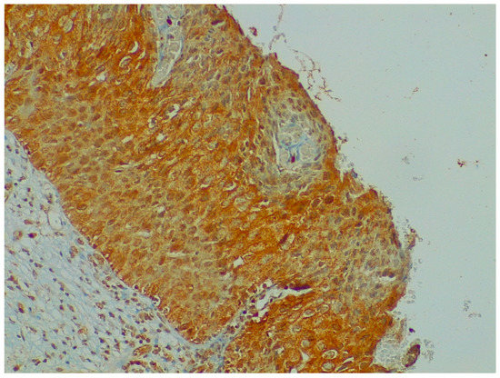 BDNF and NGF Expression in Preneoplastic Cervical Disease According to ...