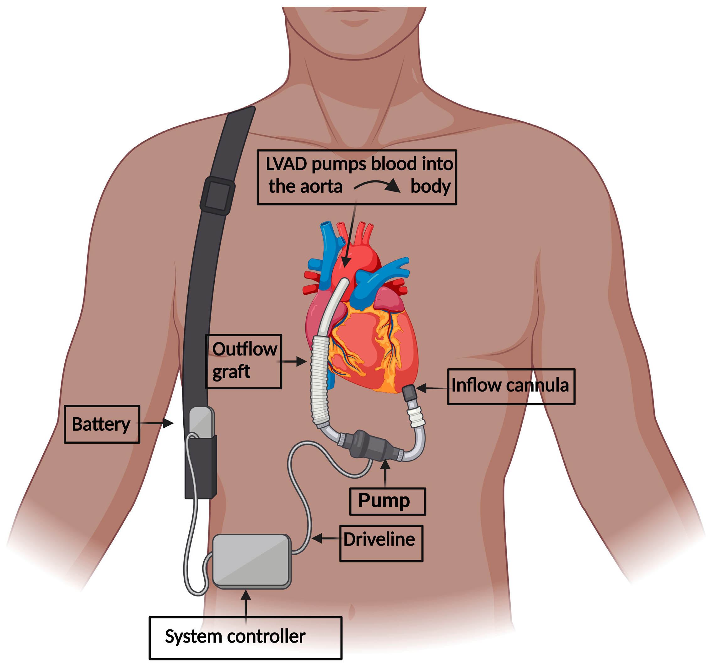 IJMS Free Full-Text Depression among Patients with an Implanted Left Ventricular Assist Device Uncovering Pathophysiological Mechanisms and Implications for Patient Care picture