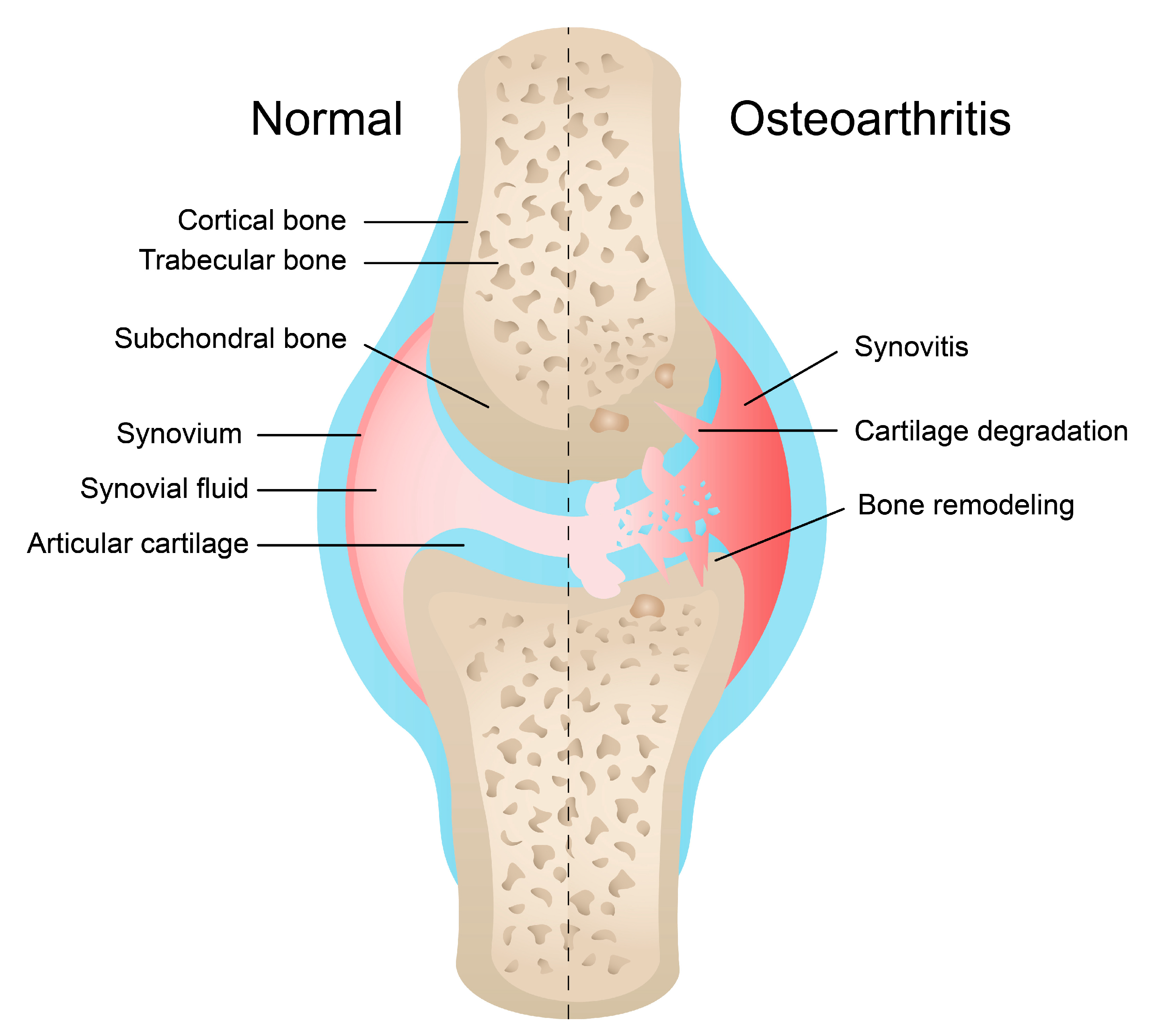 Active synovitis