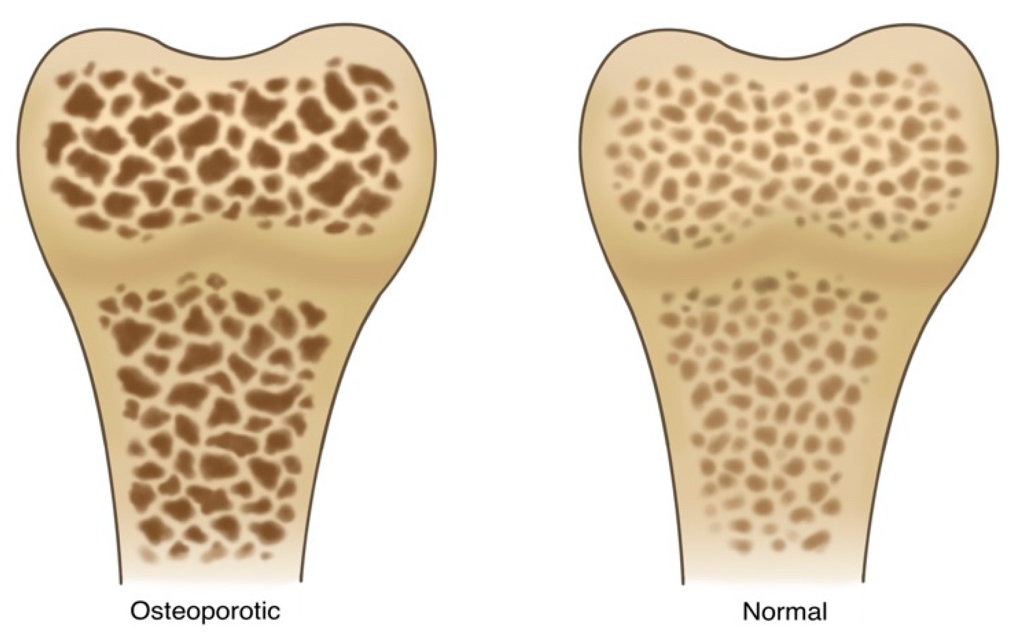 Osteoporosis Diagnóstico y tratamiento Mayo Clinic