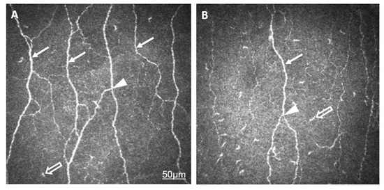 IJMS | Free Full-Text | Disrupted Neural Regeneration in Dry Eye Secondary  to Ankylosing Spondylitis—With a Theoretical Link between Piezo2  Channelopathy and Gateway Reflex, WDR Neurons, and Flare-Ups