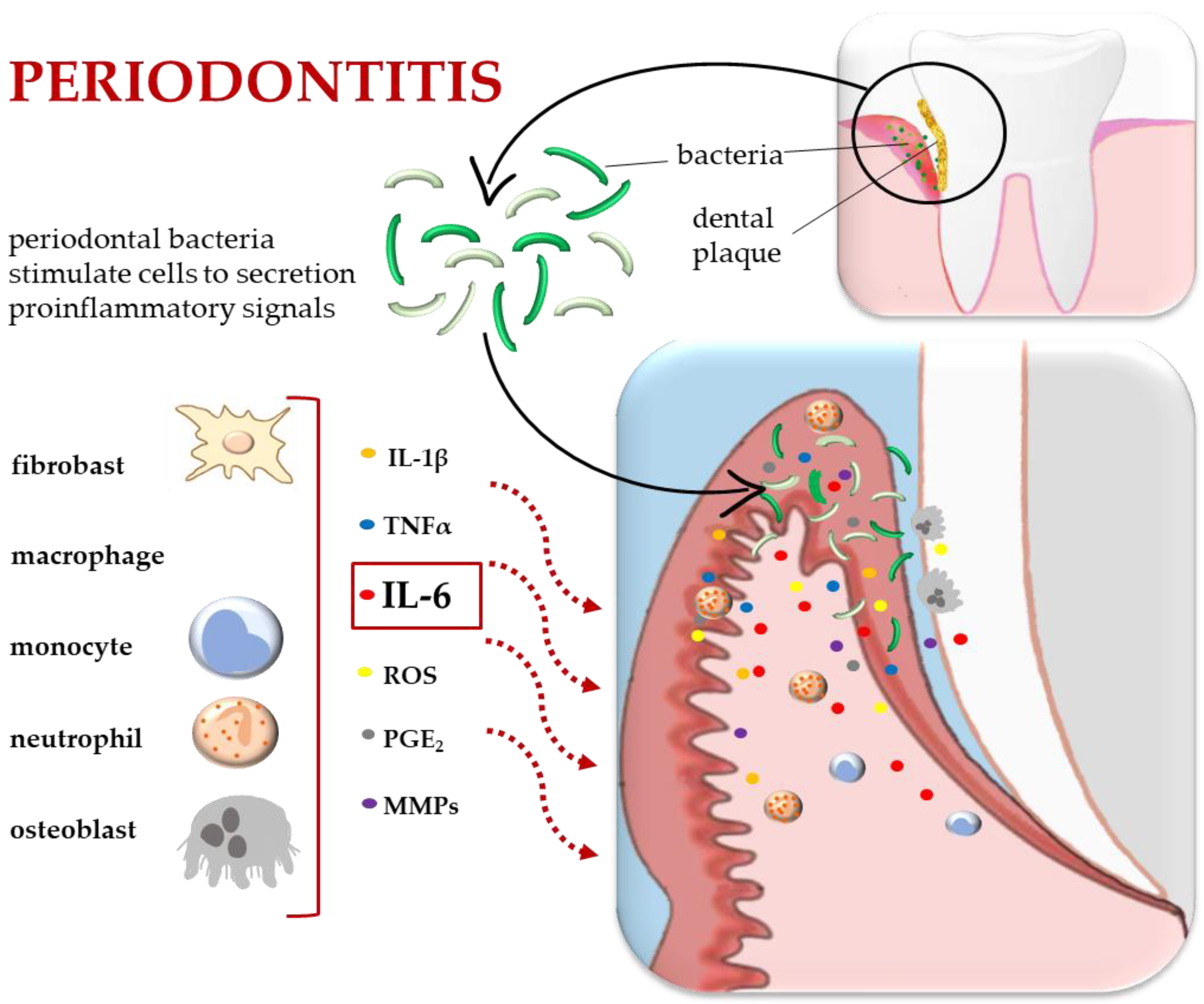 The Role of Interleukin 6 in Periodontitis and Its Complications