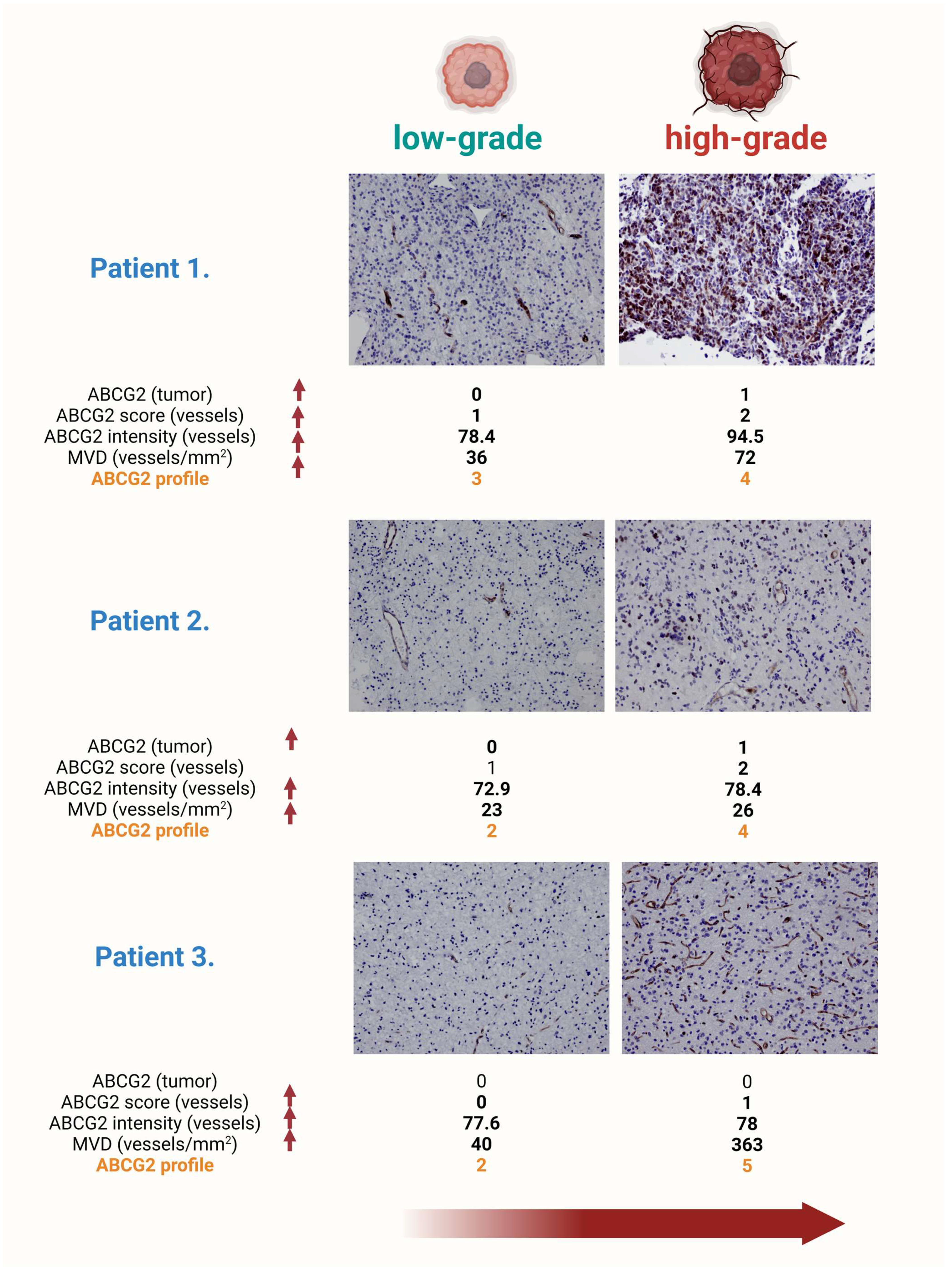 ABCG2 Expression as a Potential Survival Predictor in Human ABCG2 Expression as a Potential Survival Predictor in Human