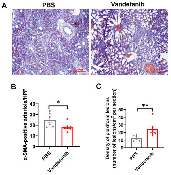 Dysregulated VEGF/VEGFR-2 Signaling and Plexogenic Lesions Dysregulated VEGF/VEGFR-2 Signaling and Plexogenic Lesions
