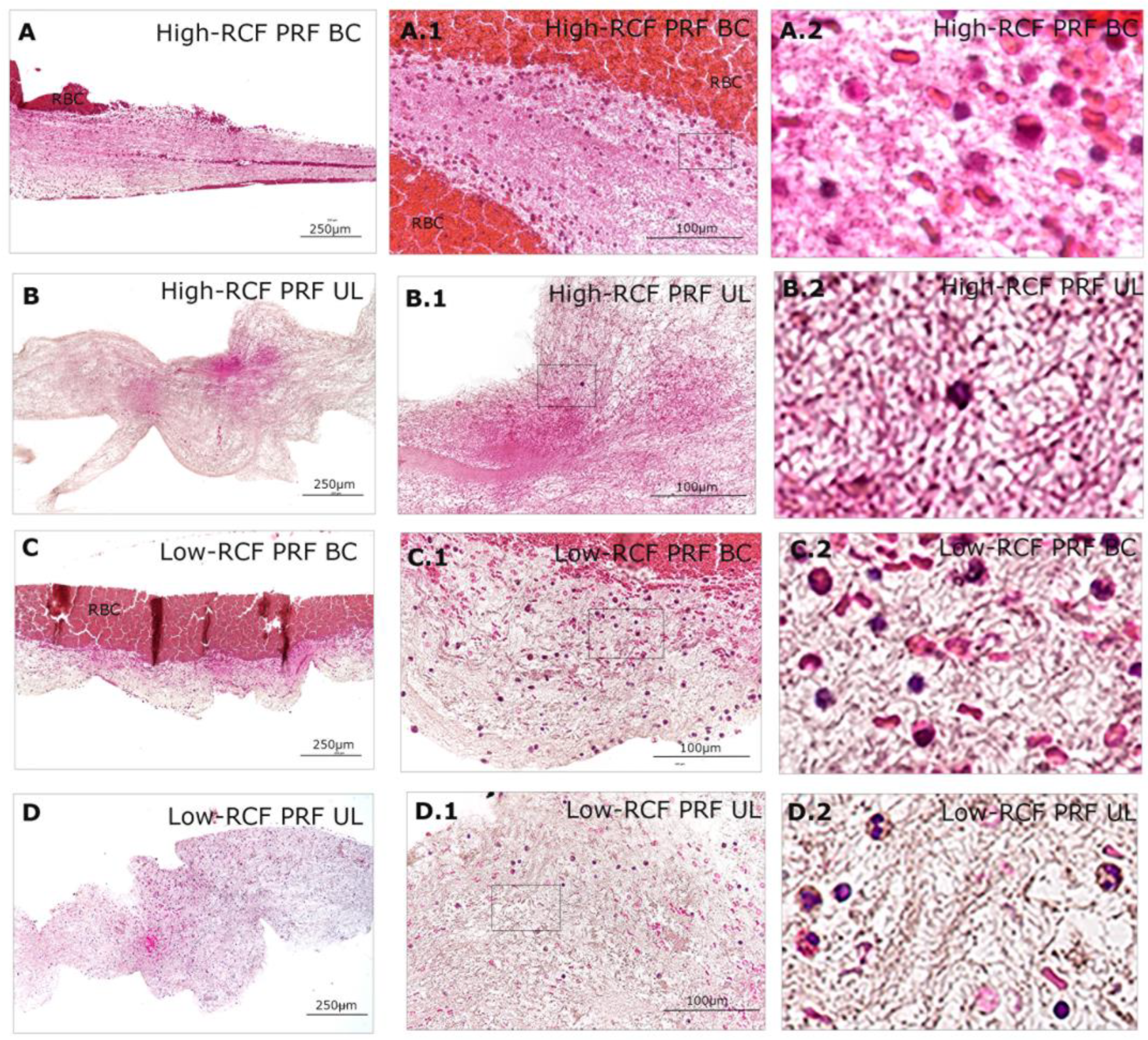 Leukocytes within Autologous Blood Concentrates Have No Impact on 